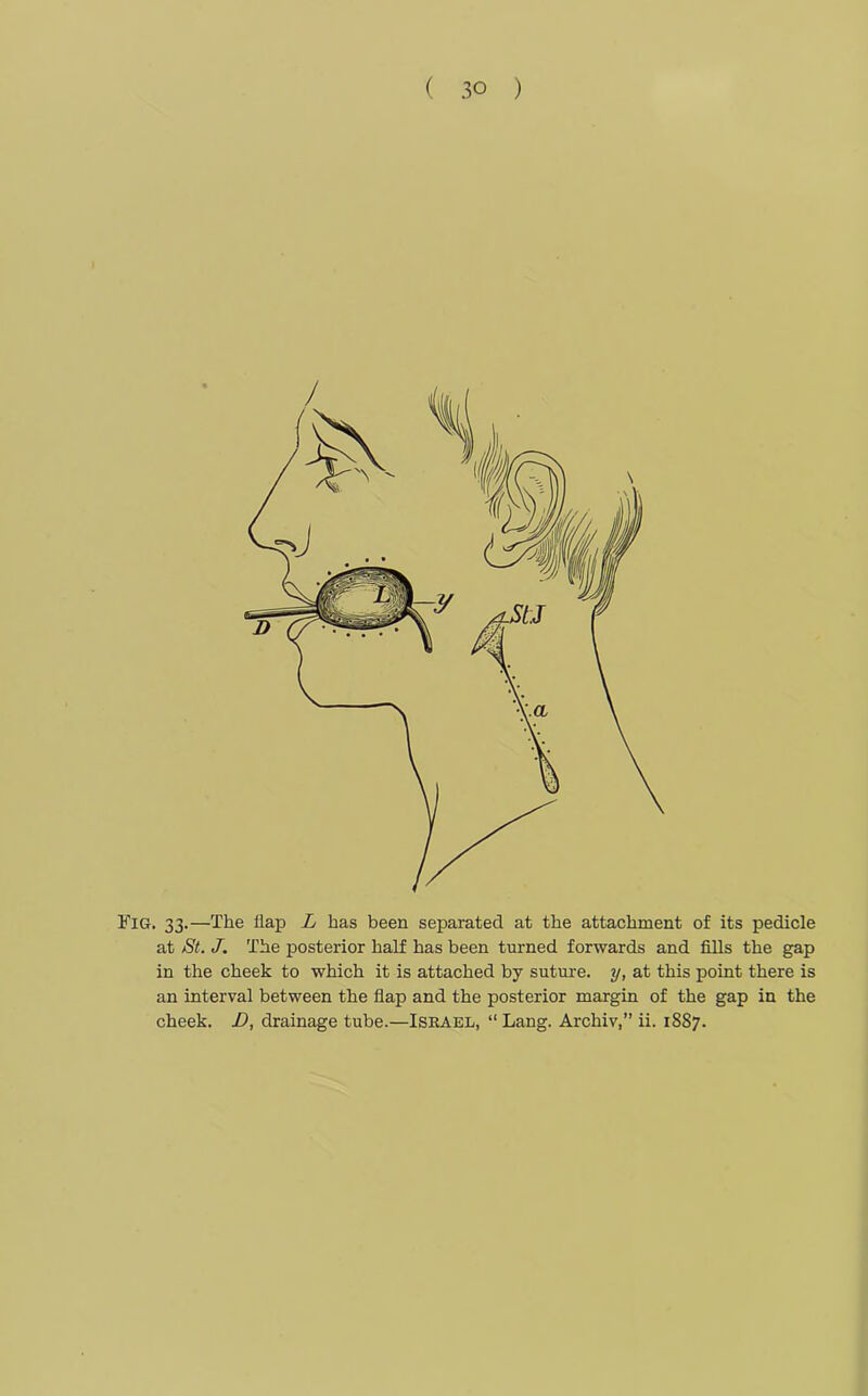 Fig. 33.—The flap L has been separated at the attachment of its pedicle at St. J. The posterior half has been turned forwards and fills the gap in the cheek to which it is attached by suture, y, at this point there is an interval between the flap and the posterior margin of the gap in the cheek. D, drainage tube.—ISRAEL, “ Lang. Archiv,” ii. 1887.