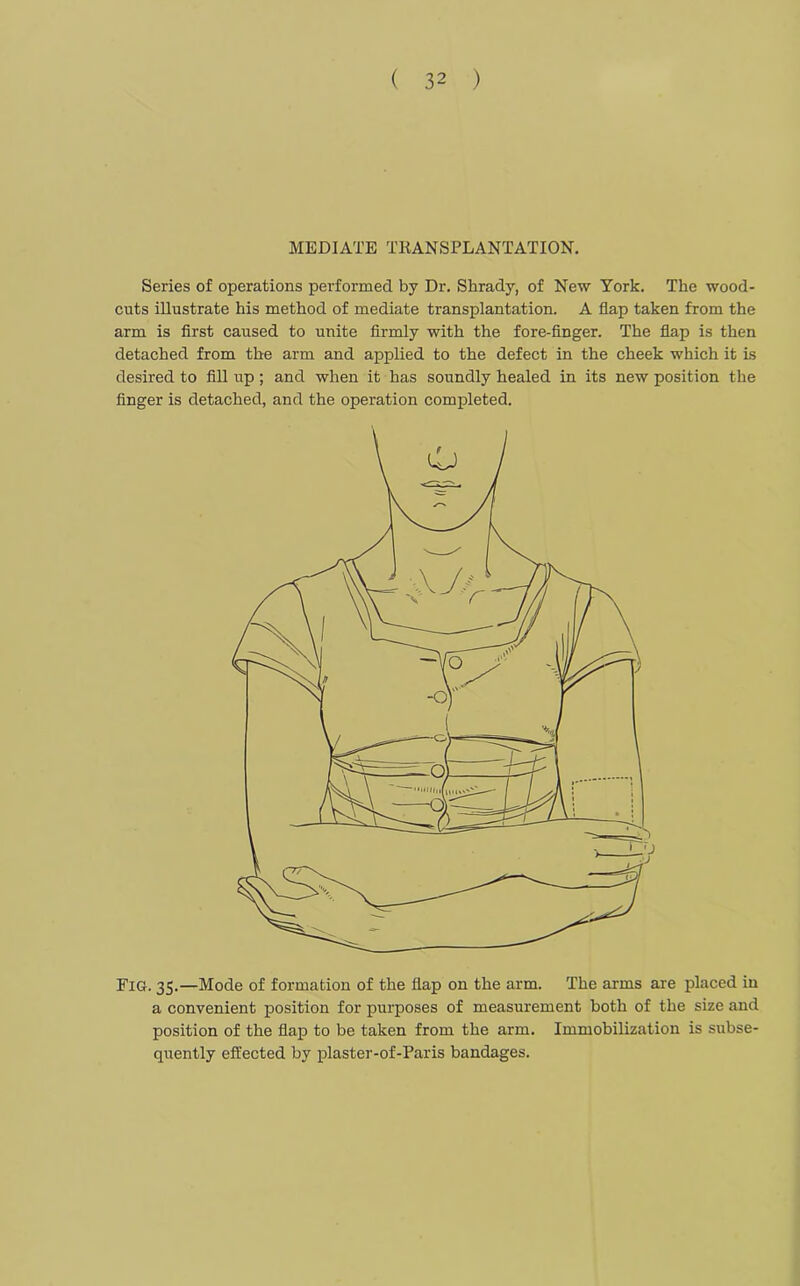 MEDIATE TRANSPLANTATION. Series of operations performed by Dr. Shrady, of New York. The wood- cuts illustrate his method of mediate transplantation. A flap taken from the arm is first caused to unite firmly with the fore-finger. The flap is then detached from the arm and applied to the defect in the cheek which it is desired to fill up ; and when it has soundly healed in its new position the finger is detached, and the operation completed. Fig. 35.—Mode of formation of the flap on the arm. The arms are placed in a convenient position for purposes of measurement both of the size and position of the flap to be taken from the arm. Immobilization is subse- quently effected by plaster-of-Paris bandages.