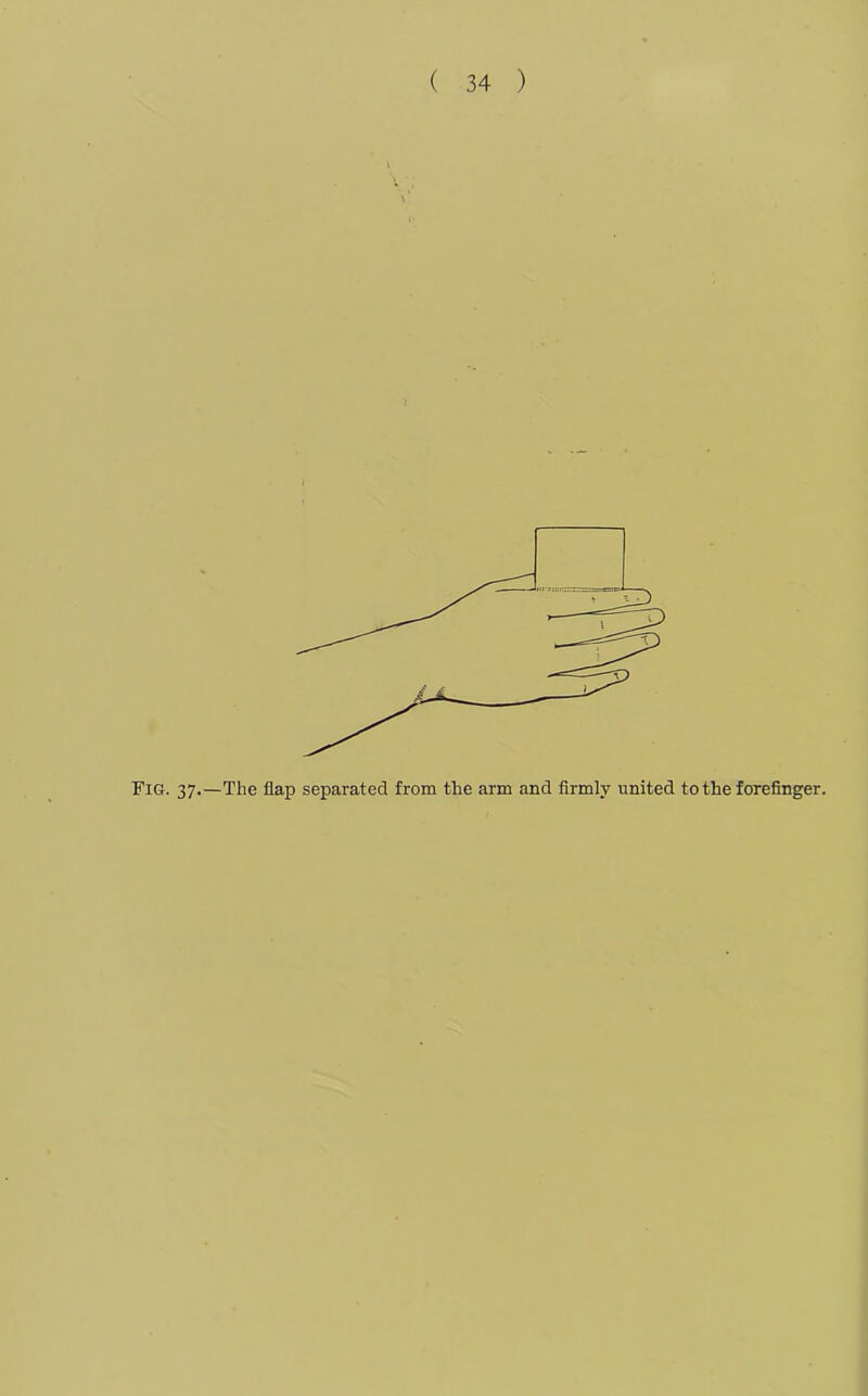 'V x1 Fig. 37.—The flap separated from the arm and firmly united to the forefinger.