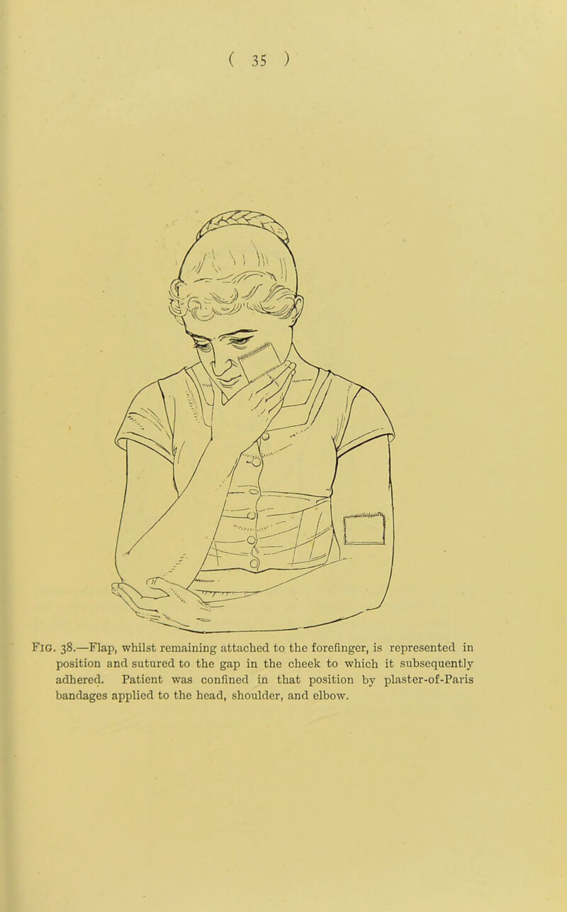 Fig. 38.—Flap, whilst remaining attached to the forefinger, is represented in position and sutured to the gap in the cheek to which it subsequently adhered. Patient was confined in that position by plaster-of-Paris bandages applied to the head, shoulder, and elbow.