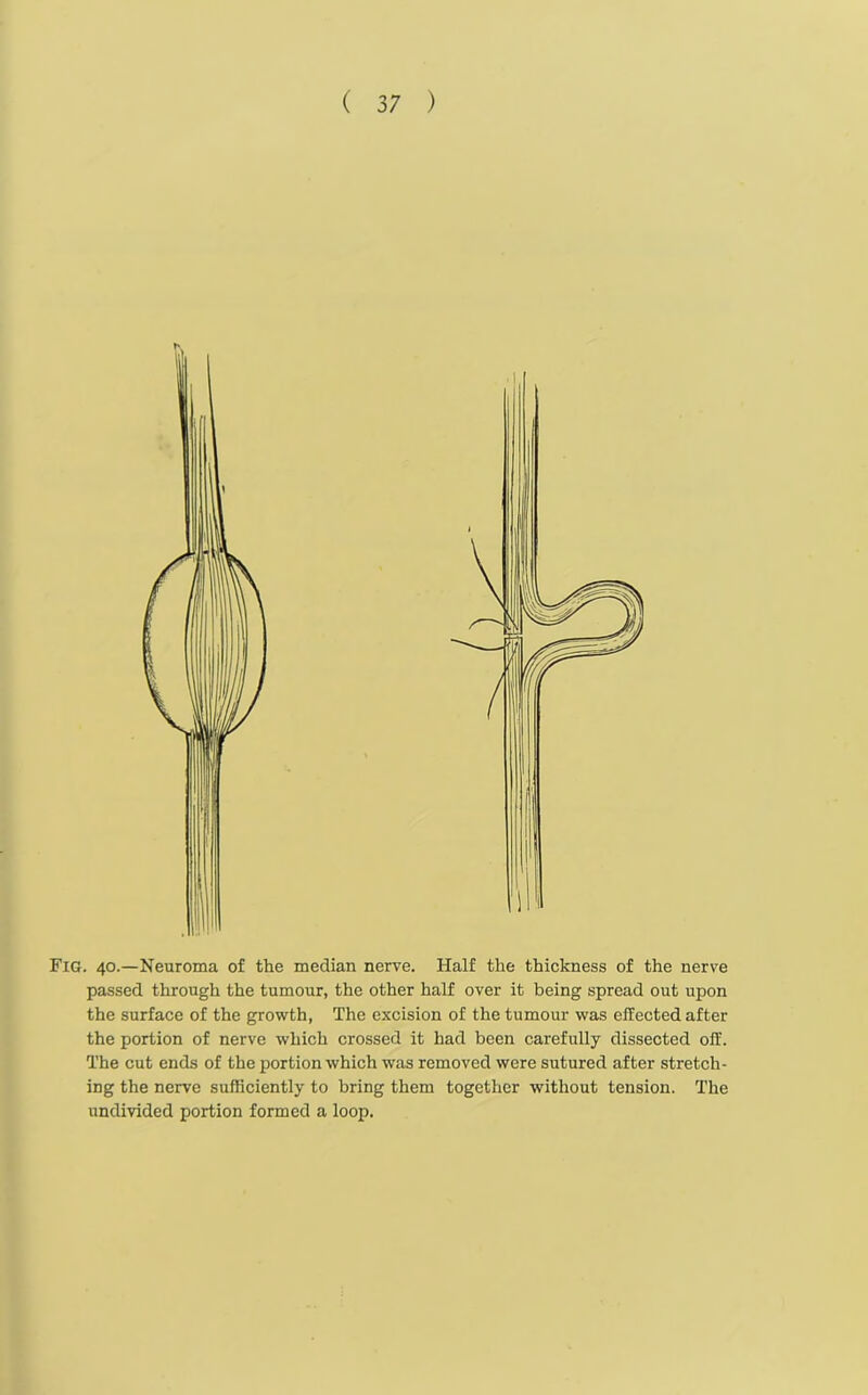 Fig. 40.—Neuroma of the median nerve. Half the thickness of the nerve passed through the tumour, the other half over it being spread out upon the surface of the growth, The excision of the tumour was effected after the portion of nerve which crossed it had been carefully dissected olf. The cut ends of the portion which was removed were sutured after stretch- ing the nerve sufficiently to bring them together without tension. The undivided portion formed a loop.