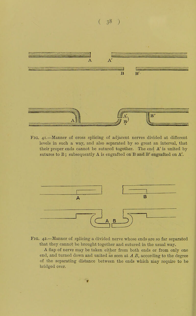 Fig. 41.—Manner of cross splicing of adjacent nerves divided at different levels in such a way, and also separated by so great an interval, that their proper ends cannot be sutured together. The end A' is united by sutures to B; subsequently A is engrafted on B and B' engrafted on A'. A Fig. 42.—Manner of splicing a divided nerve whose ends -are so far separated that they cannot be brought together and sutured in the usual way. A flap of nerve may be taken either from both ends or from only one end, and turned down and united as seen at A B, according to the degree of the separating distance between the ends which may require to be bridged over. *