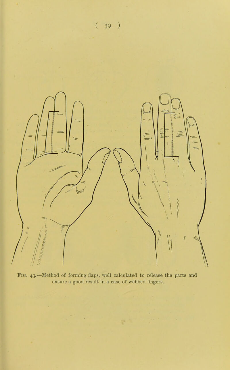 I ( 39 ) Fig. 43.—Method of forming flaps, well calculated to release the parts and ensure a good result in a case of webbed fingers. tlt/llilt////'