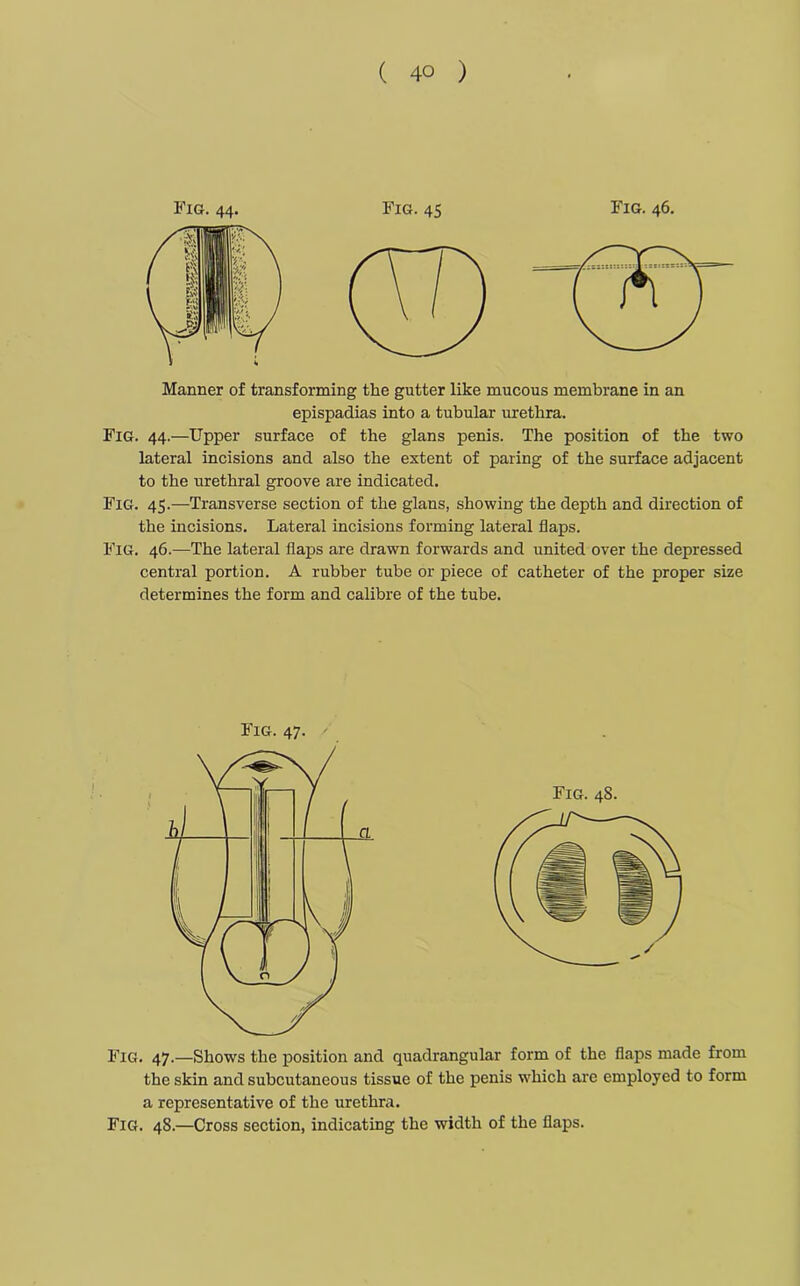 Manner of transforming the gutter like mucous membrane in an epispadias into a tubular urethra. Fig. 44.—Upper surface of the glans penis. The position of the two lateral incisions and also the extent of paring of the surface adjacent to the urethral groove are indicated. Fig. 45.—Transverse section of the glans, showing the depth and direction of the incisions. Lateral incisions forming lateral flaps. Fig. 46.—The lateral flaps are drawn forwards and united over the depressed central portion. A rubber tube or piece of catheter of the proper size determines the form and calibre of the tube. Fig. 47. Fig. 47.—Shows the position and quadrangular form of the flaps made from the skin and subcutaneous tissue of the penis which are employed to form a representative of the urethra. Fig. 48.—Cross section, indicating the width of the flaps.