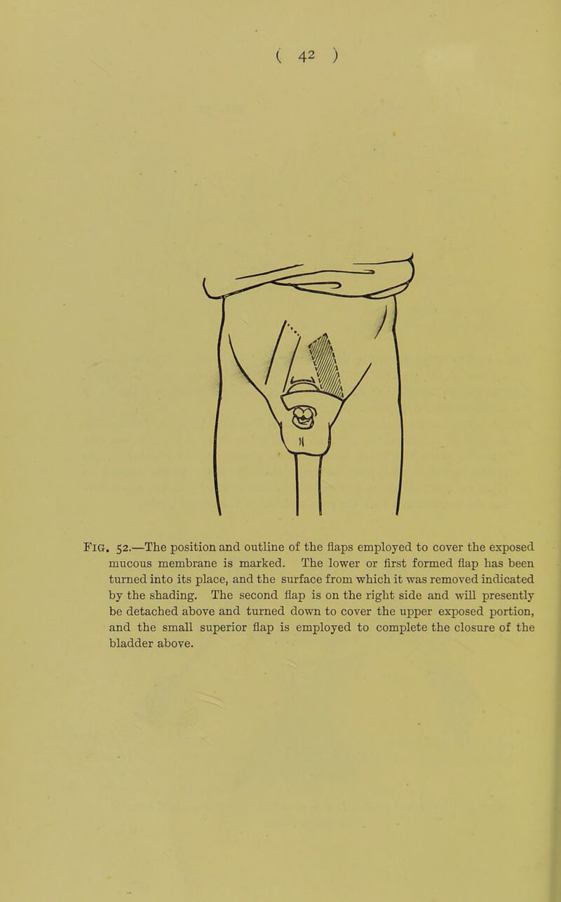 Fig. 52.—The position and outline of the flaps employed to cover the exposed mucous membrane is marked. The lower or first formed flap has been turned into its place, and the surface from which it was removed indicated by the shading. The second flap is on the right side and will presently be detached above and turned down to cover the upper exposed portion, and the small superior flap is employed to complete the closure of the bladder above.