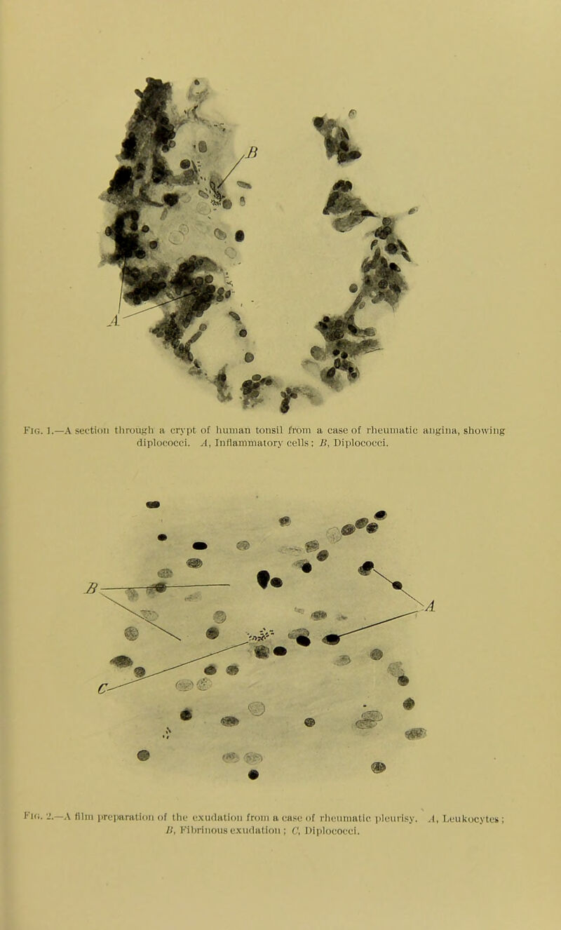 Fig. ].—A section through a crypt of human tonsil from a case of rheumatic angina, showing diplococci. A, Inflammatory cells; B, Diplococci. Fig. 2.—A film preparation of the exudation from a case of rheumatic pleurisy. .1, Leukocytes ; B, Fibrinous exudation; C, Diplococci.