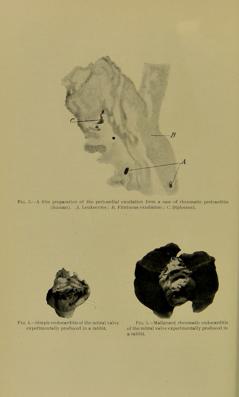 Fig. 3.—A film preparation of the pericardial exudation from a, case of rheumatic pericarditis (human). A, Leukocytes ; B, Fibrinous exudation ; c, Diplococci. Fig. 1.—Simple endocarditis of the mitral valve experimentally produced in a rabbit. Fig. 5.—Malignant rheumatic endocarditis of the mitral valve experimentally produced in a rabbit.