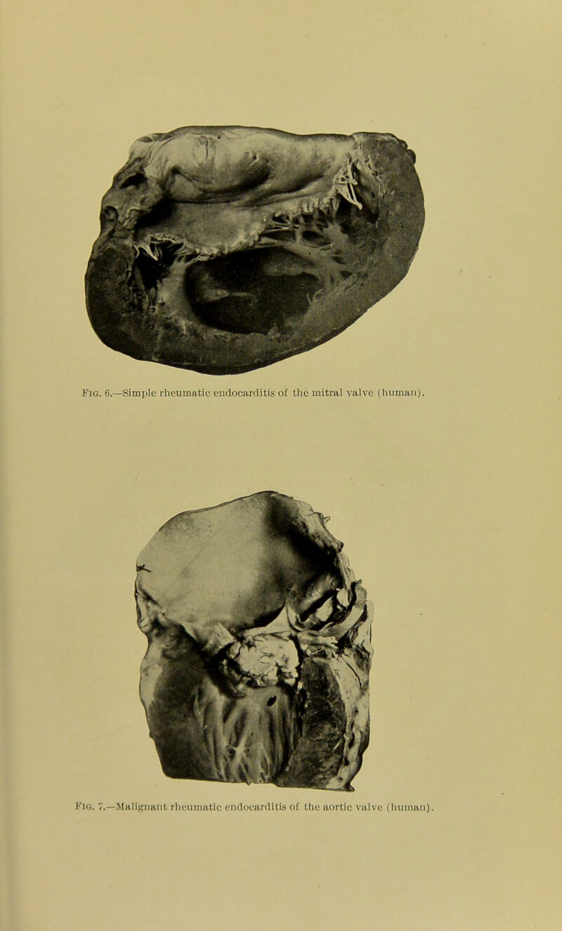 Fig. 0.—Simple rheumatic endocarditis of the mitral valve (human). Fig. 7.—Malignant rheumatic endocarditis of the aortic valve (human).