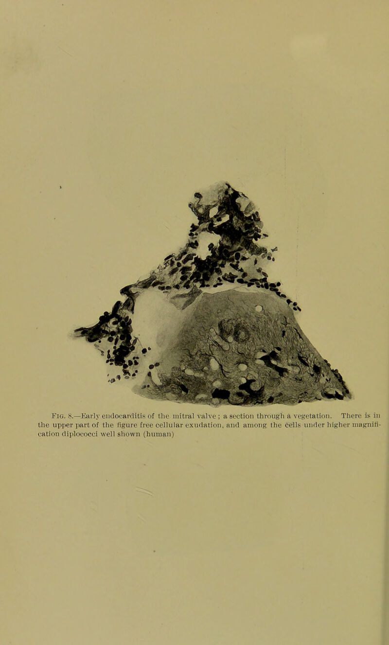 Fig. 8.—Early endocarditis of the mitral valve ; a section through a vegetation. There is in the upper part of the figure free cellular exudation, and among the cells under higher magnifi- cation diploeocei well shown (human)