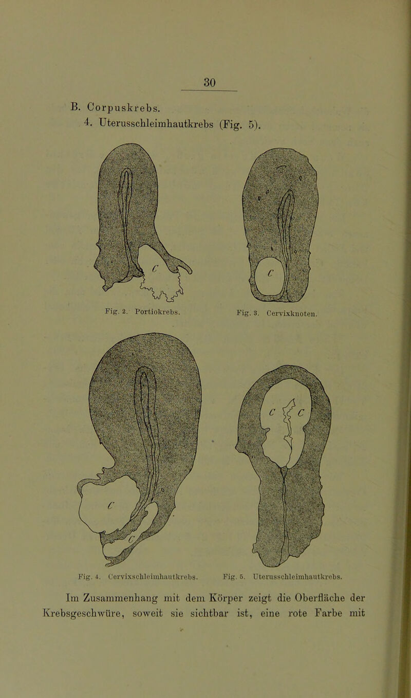 B. Corpuskrebs. 4. Uterusscbleimbautkrebs (Fig. 5). Im Zusammenhang mit dem Körper zeigt die Oberfläche der Krebsgescbwüre, soweit sie sichtbar ist, eine rote Farbe mit