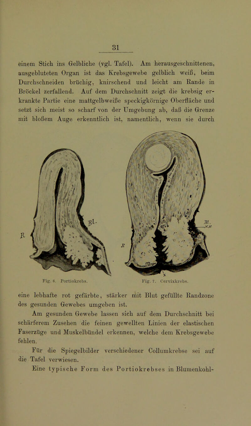 einem Stich ins Gelbliche (vgl. Tafel). Am herausgeschnittenen, ausgebluteten Organ ist das Krebsgewebe gelblich weiß, beim Durchschneiden brüchig, knirschend und leicht am Rande in Brockel zerfallend. Auf dem Durchschnitt zeigt die krebsig er- krankte Partie eine mattgelbweiße speckigkörnige Oberfläche und setzt sich meist so scharf von der Umgebung ab, daß die Grenze mit bloßem Auge erkenntlich ist, namentlich, wenn sie durch Fig. 0. Portiokrebs. Fig. 7. Cervixkrebs. eine lebhafte rot gefärbte, stärker mit Blut gefüllte Randzone des gesunden Gewebes umgeben ist. Am gesunden Gewebe lassen sich auf dem Durchschnitt bei schärferem Zusehen die feinen gewellten Linien der elastischen Faserzüge und Muskelbündel erkennen, welche dem Krebsgewebe fehlen. Für die Spiegelbilder verschiedener Collumkrebse sei auf die Tafel verwiesen. Eine typische Form des Portiokrebses in Blumenkohl-