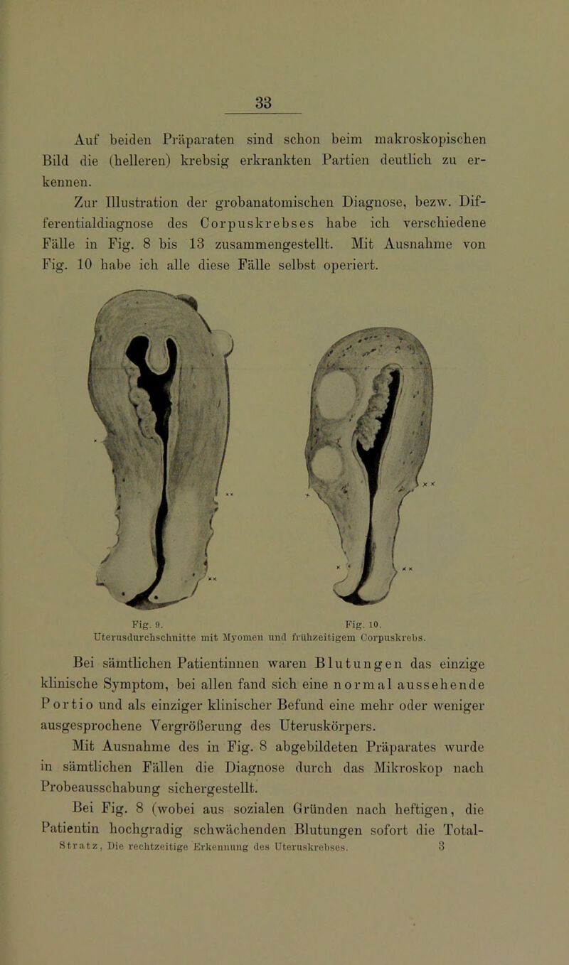 Auf beiden Präparaten sind schon beim makroskopischen Bild die (helleren) krehsig erkrankten Partien deutlich zu er- kennen. Zur Illustration der grobanatomischen Diagnose, bezw. Dif- ferentialdiagnose des Corpuskrebses habe ich verschiedene Fälle in Fig. 8 bis 13 zusammengestellt. Mit Ausnahme von o o Fig. 10 habe ich alle diese Fälle selbst operiert. Fig. 9. Fig. 10. Uterusdurchschnitte mit Myomen und frühzeitigem Corpuskrehs. Bei sämtlichen Patientinnen waren Blutungen das einzige klinische Symptom, bei allen fand sich eine normal aussehende Portio und als einziger klinischer Befund eine mehr oder weniger ausgesprochene Vergrößerung des Uteruskörpers. Mit Ausnahme des in Fig. 8 abgebildeten Präparates Avurde in sämtlichen Fällen die Diagnose durch das Mikroskop nach Probeausschabung sichergestellt. Bei Fig. 8 (wobei aus sozialen Gründen nach heftigen, die Patientin hochgradig schwächenden Blutungen sofort die Total- stratz, Die reclitzeitige Erkennung des Utcruskrehses. 3