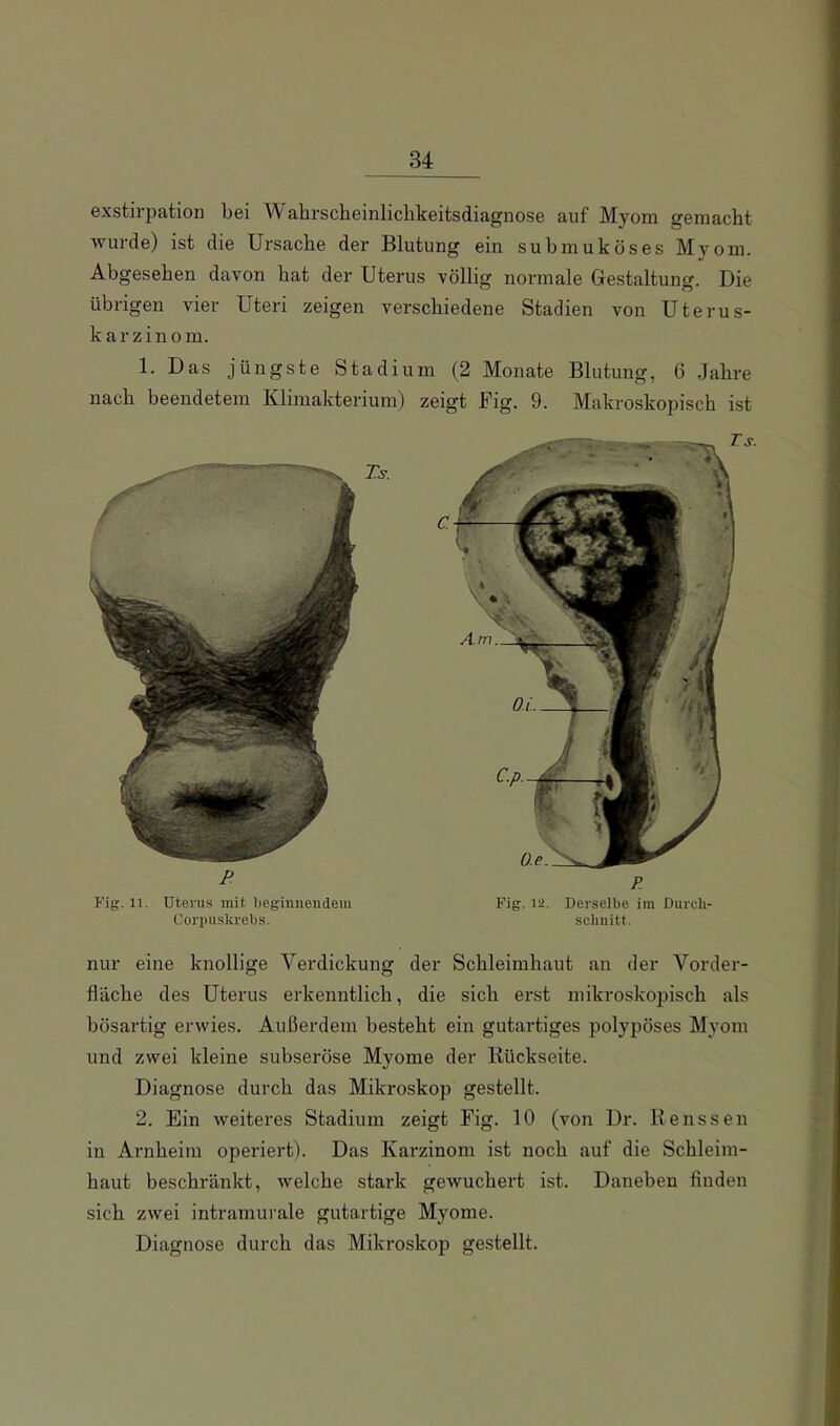 exstirpation bei abrscheinlichkeitsdiagnose auf Myom gemacht wurde) ist die Ursache der Blutung ein suhmuköses Myom. Abgesehen davon hat der Uterus völlig normale Gestaltung. Die übrigen vier Uteri zeigen verschiedene Stadien von Uterus- karzinom. 1. Das jüngste Stadium (2 Monate Blutung, 6 Jahre nach beendetem Klimakterium) zeigt Big. 9. Makroskopisch ist F Fig. 11. Uterus mit beginnendem Corpuskrebs. R Fig. 12. Derselbe im Durch- schnitt. nur eine knollige Verdickung der Schleimhaut an der Vorder- fläche des Uterus erkenntlich, die sich erst mikroskopisch als bösartig erwies. Außerdem besteht ein gutartiges polypöses Myom und zwei kleine subseröse Myome der Rückseite. Diagnose durch das Mikroskop gestellt. 2. Ein weiteres Stadium zeigt Fig. 10 (von Dr. Benssen in Arnheim operiert). Das Karzinom ist noch auf die Schleim- haut beschränkt, welche stai'k gewuchert ist. Daneben finden sich zwei intramurale gutartige Myome. Diagnose durch das Mikroskop gestellt.