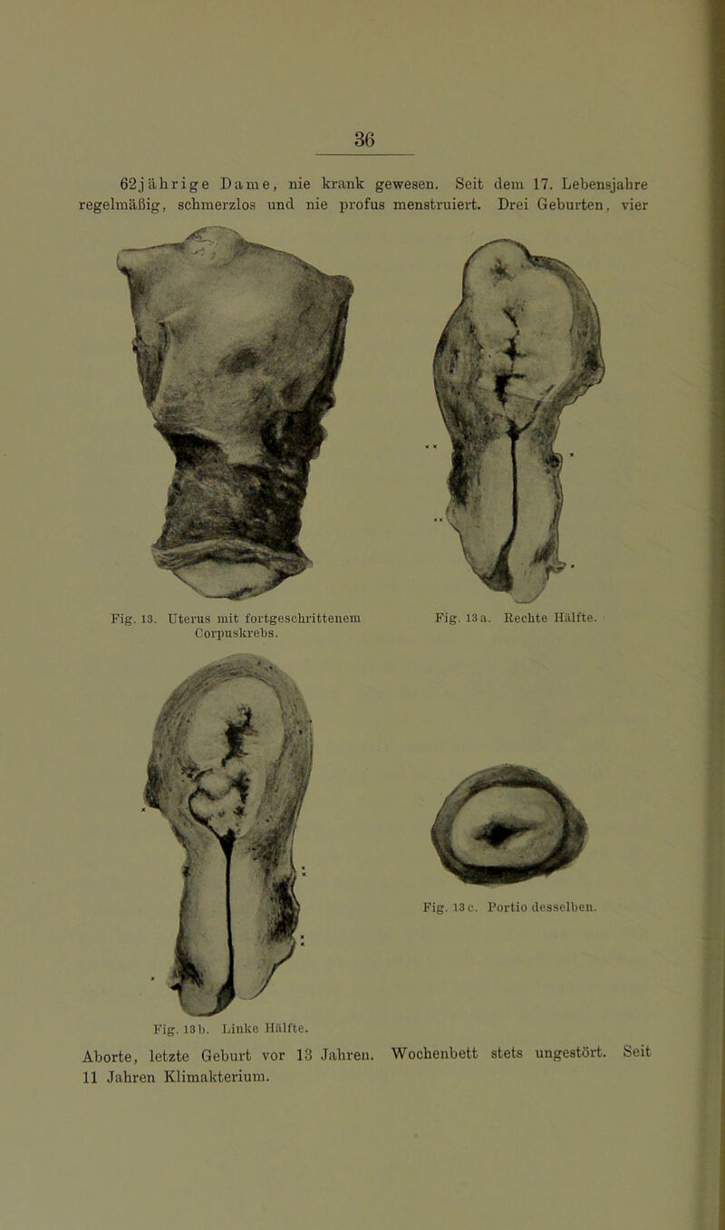 62jälirige Dame, nie krank gewesen. Seit dem 17. Lebensjahre regelmäßig, schmerzlos und nie profus menstruiert. Drei Geburten, vier Fig. 13. Uterus mit fortgeschrittenem Corpuskrehs. Fig. 13 a. Rechte Hälfte. Fig. 13 b. Linke Hälfte. Aborte, letzte Geburt vor 13 Jahren. Wochenbett stets ungestört. Seit 11 Jahren Klimakterium. Fig. 13 c. Portio desselben.