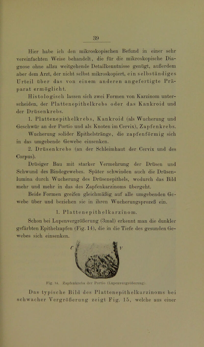 Hier habe ich den mikroskopischen Befund in einer sehr vereinfachten Weise behandelt, die für die mikroskopische Dia- gnose ohne allzu weitgehende Detailkenntnisse genügt, außerdem aber dem Arzt, der nicht selbst mikroskopiert, ein selbständiges Urteil über das von einem anderen angefertigte Prä- parat ermöglicht. Histologisch lassen .sich zwei Formen von Karzinom unter- scheiden, der Plattenepithelkrehs oder das Kankroid und der Drüsenkrebs. 1. Plattenepithelkrehs, Kankroid (als Wucherung und Geschwür an der Portio und als Knoten im Cervix), Zapfenkrebs. Wucherung solider Epithelstränge, die zapfenförmig sich in das umgehende GeAvebe einsenken. 2. Drüsenkrebs (an der Schleimhaut der Cervix und des Corpus). Drüsiger Bau mit starker Vermehrung der Drüsen und Schwund des Bindegewebes. Später schwinden auch die Drüsen- lumina durch Wucherung des Drüsenepithels, wodurch das Bild mehr und mehr in das des Zapfenkarzinoms übergeht. Beide Formen greifen gleichmäßig auf alle umgebenden Ge- webe über und beziehen sie in ihren Wucherungsprozeß ein. 1. P1 a 11 e n e p i t h e 1 k a r z i n 0 m. Schon bei Lupenvergrößerung (3mal) erkennt man die dunkler gefärbten Epithelzapfen (Fig. 14), die in die Tiefe des gesunden Ge- webes sich einsenken. Fig. M. Zapfeiikvelis der Portio (Lupenvergrolieruiig). Das typische Bild des Plattenepithelkarzinoms bei