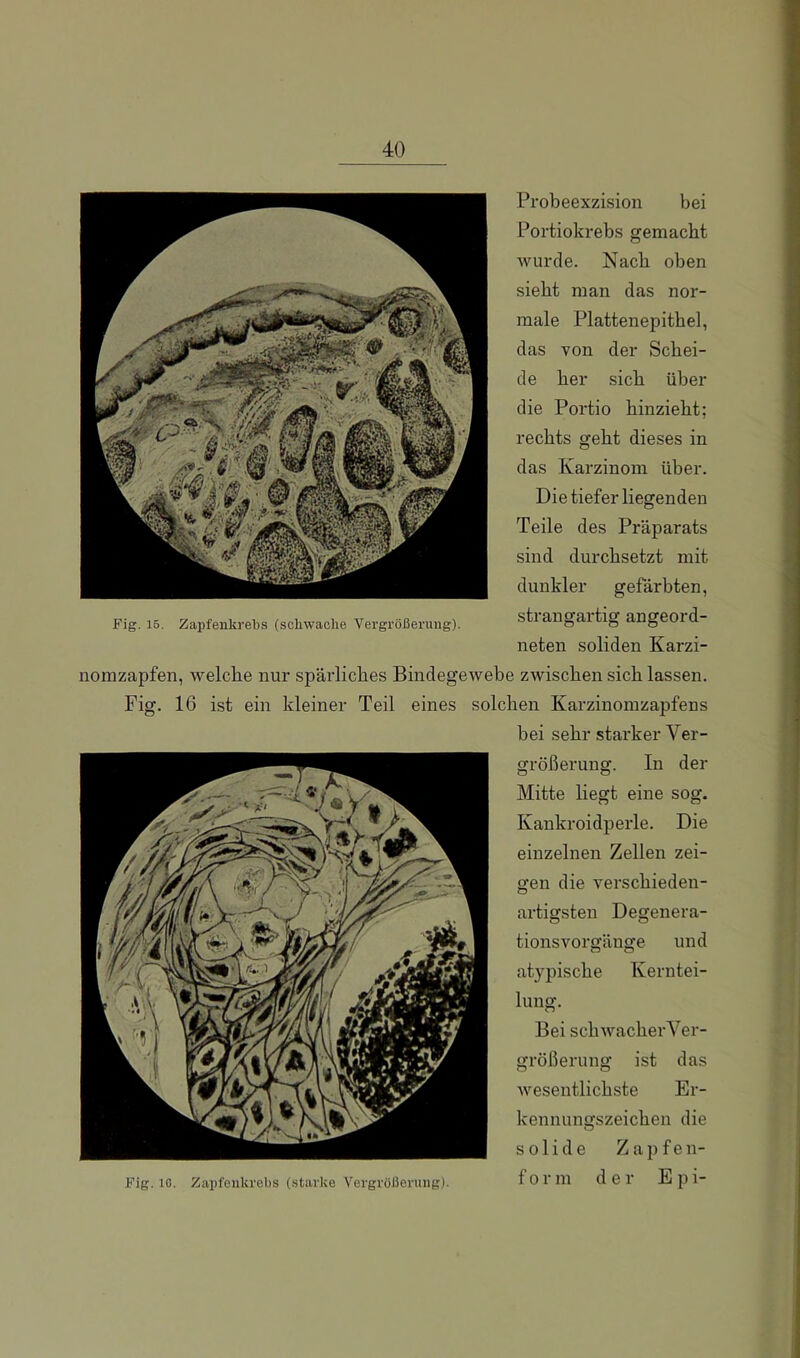 Fig. 16. Zapfenkrebs (scliwaclie Vergrößerung). Probeexzision bei Portiokrebs gemacht wurde. Nach oben siebt man das nor- male Plattenepitbel, das von der Schei- de her sieb über die Portio binziebt; rechts gebt dieses in das Karzinom über. Die tiefer liegenden Teile des Präparats sind durchsetzt mit dunkler gefärbten, strangartig angeord- neten soliden Karzi- nomzapfen, welche nur spärliches Bindegewebe zwischen sich lassen. Fig. 16 ist ein kleiner Teil eines solchen Karzinomzapfens bei sehr starker Ver- größerung. In der Mitte liegt eine sog. Kankroidperle. Die einzelnen Zellen zei- gen die verschieden- artigsten Degenera- tionsvorgänge und atypische Kerntei- lung. Bei schivacher Ver- größerung ist das wesentlichste Er- kennungszeichen die solide Zapfen- Fig. 16. Zapfonki'cbs (starke Vergrößerung). form der E p 1-