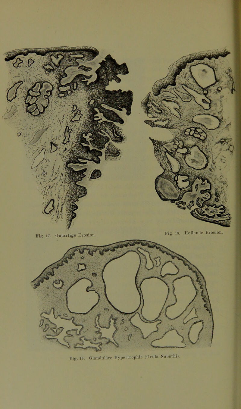 Fig. 17. Gutartige Erosion. Fig. 19. Glandulilre llypertroiiliio (Ovula Naliothi). i