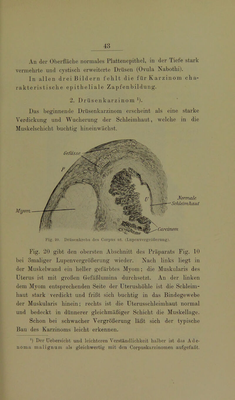 48 An der Oberfläclie normales Plattenepithel, in der Tiefe stark vermehrte und cystisch erweiterte Drüsen (Ovula Nabothi). In allen drei Bildern fehlt die für Karzinom cha- rakteristische epitheliale Zapfenbildung. 2. DrüsenkarzinomO- Das beginnende Drüsenkarzinom erscheint als eine starke Verdickung und Wucherung der Schleimhaut, welche in die Muskelschicht buchtig hineiuwächst. Fig. 20. Drüsenkriibs des Corpus ut. (Lupcnvergrüßeruiig). Fig. 20 gibt den obersten Abschnitt des Präparats Fig. 10 bei Smaliger Lupenvergrößerung Avieder. Nach links liegt in der Muskelwand ein heller gefärbtes Myom; die Muskularis des Uterus ist mit großen Gefäßlumina durchsetzt. An der linken dem Myom entsprechenden Seite der Uterushöhle ist die Schleim- haut stark verdickt und frißt sich buchtig in das Bindegewebe der Muskularis hinein; rechts ist die Uterusschleimhaut normal und bedeckt in dünnerer gleichmäßiger Schicht die Muskellage. Schon bei schwacher Vergrößerung läßt sich der typische Bau des Karzinoms leicht erkennen. ') Der Uebersicht und leichteren Verständlichkeit halber ist das Ade- noma malignum als gleichwertig mit den Corpuskarzinomen aufgefaßt.