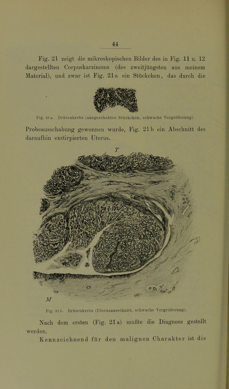 Fig. 21 zeigt die mikroskopischen Bilder des in Fig. 11 u. 12 dargestellten Corpuskarzinoms (des zweitjüngsten aus meinem Material), und zwar ist Fig. 21a ein Stückchen, das durch die Fig. 21a. Drüsenkrebs (ausgeschabtes Stückchen, schwache Vergrößerung). Probeausschahung gewonnen wurde, Fig. 21b ein Abschnitt des daraufhin exstirpierten Uterus. T Fig. 21b. Drüsenkrebs (üterusausschnitt, schwache Vergrößerung). Nach dem ersten (Fig. 21a) mußte die Diagnose gestellt werden. Kennzeichnend für den malignen Charakter ist die