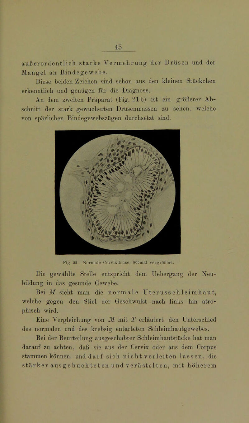 außerordeiitlicli starke Vermelirung der Drüsen und der Mangel an Bindegewebe. Diese beiden Zeiclien sind schon aus den kleinen Stückchen erkenntlich und genügen für die Diagnose. An dem zweiten Präparat (Fig. 21b) ist ein größerer Ab- schnitt der stark gewucherten Drüsenmasseu zu sehen, welche von spärlichen Bindegewebszügen durchsetzt sind. Fig. 22. Normale Cervixdrüse, SOOmal vergrößert. Die gewählte Stelle entspricht dem Uebergang der Neu- bildung in das gesunde GeAvebe. Bei M sieht man die normale Uterusschleimhaut, welche gegen den Stiel der GeschAvulst nach links hin atro- phisch wird. Eine Vergleichung von M mit T erläutert den Unterschied des normalen und des krebsig entarteten SchleimhautgeAvebes. Bei der Beurteilung ausgeschabter Schleimhautstücke hat man darauf zu achten, daß sie aus der Cervix oder aus dem Corpus stammen können, und darf sich nicht verleiten lassen, die stärker ausgebuchteten und verästelten, mit höherem