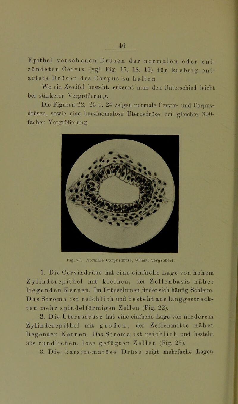 4G Epithel versehenen Drüsen der normalen oder ent- zündeten Cervix (vgl. Fig. 17, 18, 19) für krebsig ent- artete Drüsen des Corpus zu halten. Wo ein Zweifel besteht, erkennt man den Unter.schied leicht bei stärkerer Vergrößerung. Die Figuren 22, 23 u. 24 zeigen normale Cervix- und Corpus- drüsen, sowie eine karzinomatöse UterusdrUse bei gleicher 800- facher Vergrößerung. Fig. 23. Normale Corpusdrüse, SOOmal vergrößert. 1. Die Cervixdrüse hat eine einfache Lage von hohem Zylinderepithel mit kleinen, der Zellenbasis näher liegenden Kernen. Im Drüsenlumen findet sich häufig Schleim. Das Stroma ist reichlich und besteht aus langgestreck- ten mehr spindelförmigen Zellen (Fig. 22). 2. Die Uterusdrüse hat eine einfache Lage von niederem Zylinderepithel mit großen, der Zellenmitte näher liegenden Kernen. Das Stroma ist reichlich und besteht aus rundlichen, lose gefügten Zellen (Fig. 23). 3. Die karzinomatöse Drüse zeigt mehrfache Lagen