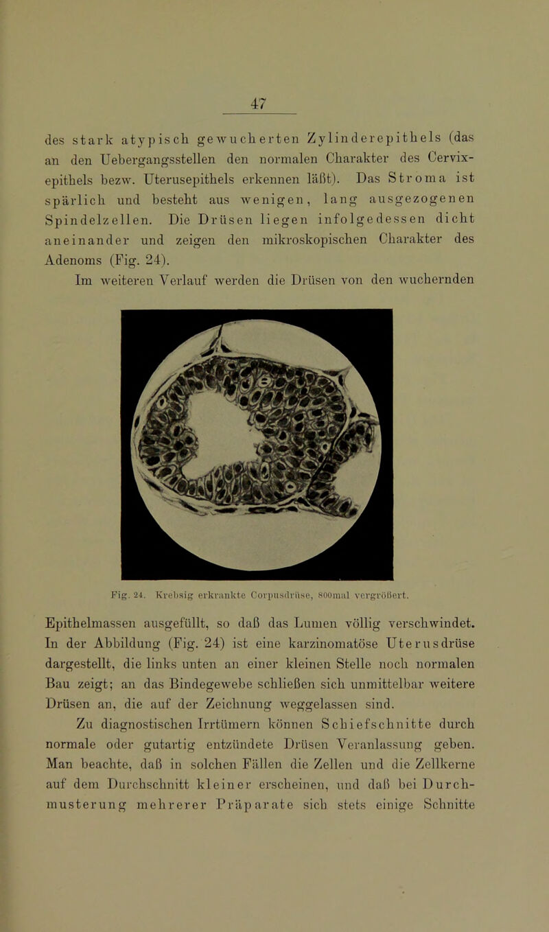 des stai-k atypisch geAvucherten Zylinderepithels (das an den Uebergangsstellen den normalen Charakter des Cervix- epithels bezw. Uterusepithels erkennen läßt). Das Stroma ist spärlich und besteht aus Avenigen, lang ausgezogenen Spindelzellen. Die Drüsen liegen infolgedessen dicht aneinander und zeigen den mikroskopischen Charakter des Adenoms (Fig. 24). Im Aveiteren Verlauf Averden die Drüsen von den Avuchernden Fig. 24. Kvebsig erkrankte Coi'iuisdrii.se, soomal vergröliert. Epithelmassen ausgefüllt, so daß das Lumen völlig verschwindet. In der Abbildung (Fig. 24) ist eine karzinomatöse Uterusdrüse dargestellt, die links unten an einer kleinen Stelle noch normalen Bau zeigt; an das BindegeAvebe schließen sich unmittelbar Aveitere Drüsen an, die auf der Zeichnung Aveggelassen sind. Zu diagnostischen Irrtümern können Schiefschnitte durch normale oder gutartig entzündete Drüsen Veranlassung gehen. Man beachte, daß in solchen Fällen die Zellen und die Zellkerne auf dem Durchschnitt kleiner erscheinen, und daß bei Durch- musterung mehrerer Präparate sich stets einige Schnitte