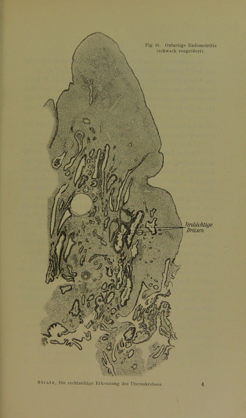 Fig. 26. Ciutai-tige Kmlometritis (schwach vergrößert).