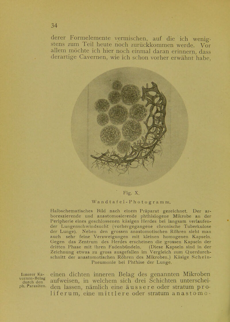 Innerer Ka- vernen-Belag durch den ph. Parasiten. derer Formelemente vermischen, auf die ich wenig- stens zum Teil heute noch zurückkommen werde. Vor allem möchte ich hier noch einmal daran erinnern, dass derartige Cavernen, wie ich schon vorher erwähnt habe. Fig. x. Wandtafel-Photogramm, Halbschematisches Pild nach einem Präparat gezeichnet. Der ar- boreszierende und anastomosierende phthisiogene Mikrobe an der Peripherie eines geschlossenen käsigen Herdes bei langsam verlaufen- der Lungenschwindsucht (vorhergegangene chronische Tuberkulose der Lunge). Neben den grossen anastomotischen Röhren sieht man auch sehr feine Verzweigungen mit kleinen homogenen Kapseln. Gegen das Zentrum des Herdes erscheinen die grossen Kapseln der dritten Phase mit ihren Fadenbündeln. (Diese Kapseln sind in der Zeichnung etwas zu gross ausgefallen im Vergleich zum Querdurch- schnitt der anastomotischen Röhren des Mikroben.) Käsige Schein- Pneumonie bei Phthise der Lunge. einen dichten inneren Belag des genannten Mikroben aufweisen, in welchem sich drei Schichten unterschei- den lassen, nämlich eine äussere oder Stratum pro- 1 i f e r u m, eine mittlere oder Stratum anastomo-