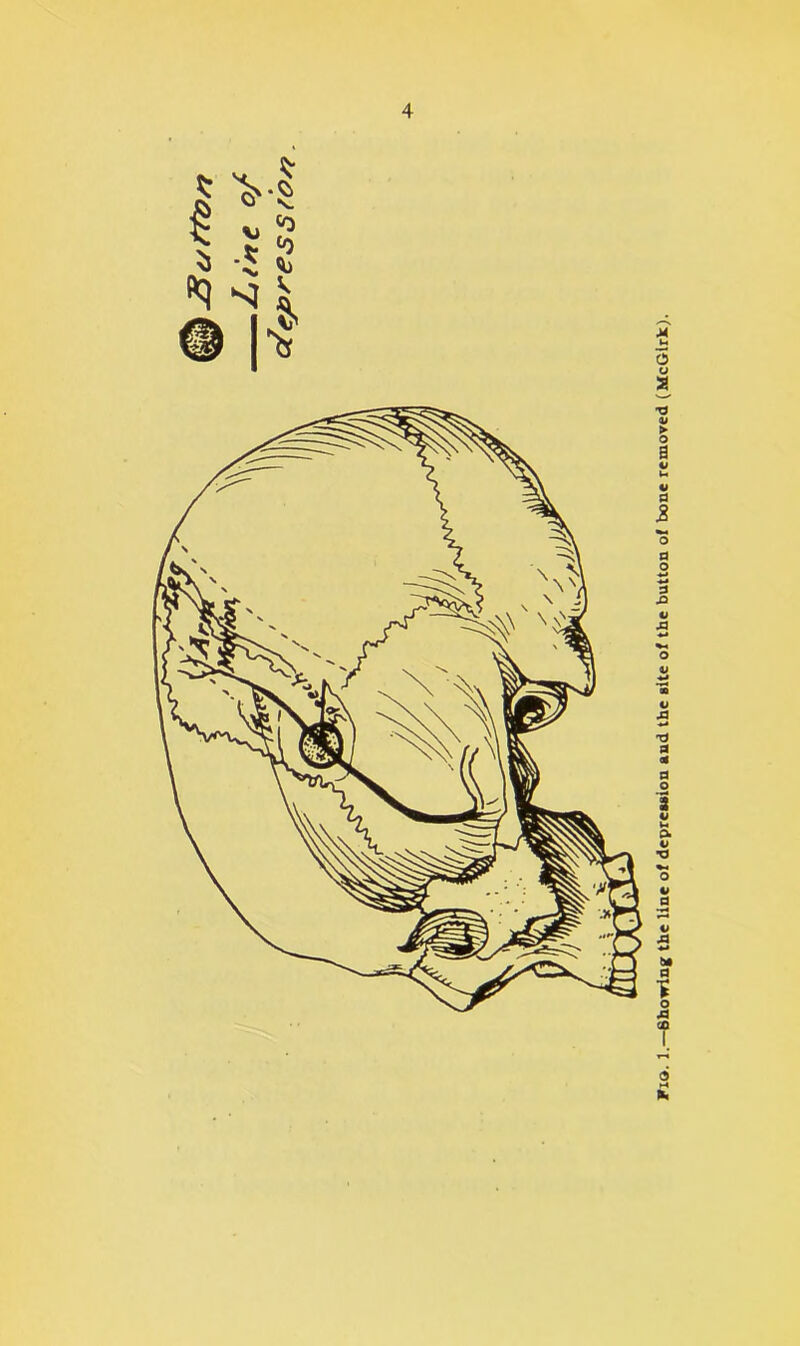 Tia. 1.—Showing the line of depression and the site of the button of bone removed (McGirk).