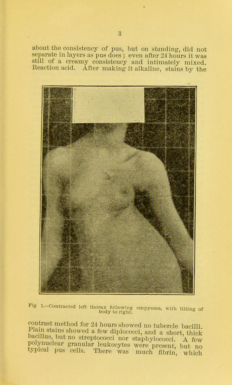 about the consistency of pus, but on standing, did not separate in layers as pus does ; even after 24 hours it was still of a creamy consistency and intimately mixed. Reaction acid. After making it alkaline, stains by the Fig 1. Contracted left thorax following empyema, with tilting of body to right. b contrast method for 24 hours showed no tubercle bacilli. I lain stains showed a few diplococci, and a short, thick taciJlus, but no streptococci nor staphylococci. A few po ynuclear granular leukocytes were present, but no typical pus cells. There was much fibrin, which