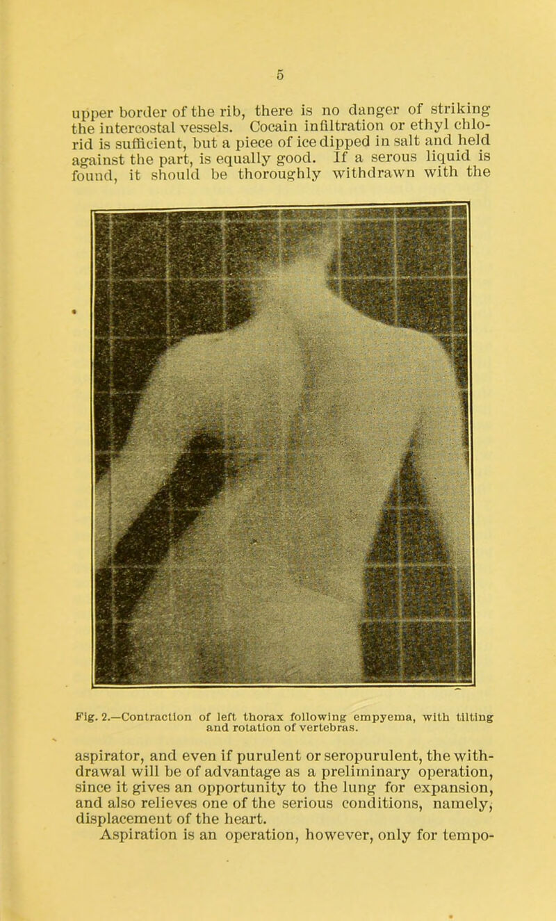 0 upper border of the rib, there is no danger of striking the intercostal vessels. Cocain infiltration or ethyl chlo- rid is sufficient, but a piece of ice dipped in salt and held against the part, is equally good. If a serous liquid is found, it should be thoroughly withdrawn with the Fig. 2.—Contraction of left thorax following empyema, with tilting and rotation of vertebras. aspirator, and even if purulent or seropurulent, the with- drawal will be of advantage as a preliminary operation, since it gives an opportunity to the lung for expansion, and also relieves one of the serious conditions, namely, displacement of the heart. Aspiration is an operation, however, only for tempo-