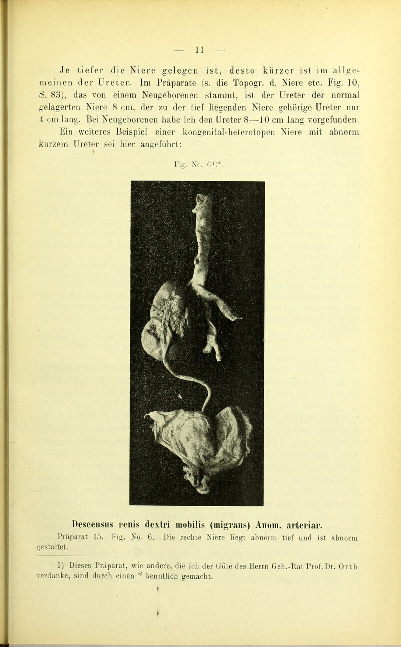 Je tiefer die Niere gelegen ist, desto kürzer ist im allge- meinen der Ureter. Im Präparate (s. die Topogr. d. Niere etc. Fig. 10, S. 83), das von einem Neugeborenen stammt, ist der Ureter der normal gelagerten Niere 8 cm, der zu der tief liegenden Niere gehörige Ureter nur 4 cm lang. Bei Neugeborenen habe ich den Ureter 8—10 cm lang vorgefunden. Ein weiteres Beispiel einer kongenital-heterotopen Niere mit abnorm kurzem Ureter sei hier angeführt: Fig. No. 6i)*. Descensns renis dextri mobilis (migrans) Anom. arteriar. Präparat 15. Fig. No. 6. Oie rechte Niere liegt abnorm tief und ist abnorm gestaltet. 1) Dieses Präparat, wie andere, die ich der Güte des Herrn Geh.-Rat Prof.Dr. Orth verdanke, sind durch einen * kenntlich gemacht. i