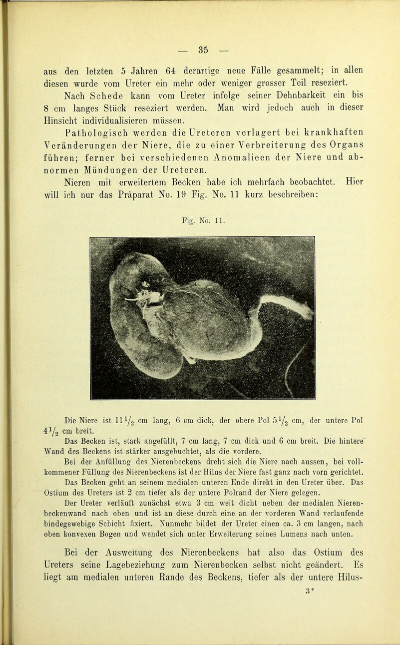 aus den letzten 5 Jahren 64 derartige neue Fälle gesammelt; in allen diesen wurde vom Ureter ein mehr oder weniger grosser Teil reseziert. Nach Schede kann vom Ureter infolge seiner Dehnbarkeit ein bis 8 cm langes Stück reseziert werden. Man wird jedoch auch in dieser Hinsicht individualisieren müssen. Pathologisch werden die Ureteren verlagert bei krankhaften Veränderungen der Niere, die zu einer Verbreiterung des Organs führen; ferner bei verschiedenen Anomalieen der Niere und ab- normen Mündungen der Ureteren. Nieren mit erweitertem Becken habe ich mehrfach beobachtet. Hier will ich nur das Präparat No. 19 Fig. No. 11 kurz beschreiben: Fig. No. 11. Die Niere ist 111/2 cm lang, 6 cm dick, der obere Pol 51L cm, der untere Pol 41/2 cm breit. Das Becken ist, stark angefüllt, 7 cm lang, 7 cm dick und 6 cm breit. Die hintere Wand des Beckens ist stärker ausgebuchtet, als die vordere. Bei der Anfüllung des Nierenbeckens dreht sich die Niere nach aussen, bei voll- kommener Füllung des Nierenbeckens ist der Hilus der Niere fast ganz nach vorn gerichtet. Das Becken geht an seinem medialen unteren Ende direkt in den Ureter über. Das Ostium des Ureters ist 2 cm tiefer als der untere Polrand der Niere gelegen. Der Ureter verläuft zunächst etwa 3 cm weit dicht neben der medialen Nieren- beckenwand nach oben und ist an diese durch eine an der vorderen Wand verlaufende bindegewebige Schicht fixiert. Nunmehr bildet der Ureter einen ca. 3 cm langen, nach oben konvexen Bogen und wendet sich unter Erweiterung seines Lumens nach unten. Bei der Ausweitung des Nierenbeckens hat also das Ostium des Ureters seine Lagebeziehung zum Nierenbecken selbst nicht geändert. Es liegt am medialen unteren Rande des Beckens, tiefer als der untere Hilus- 3*