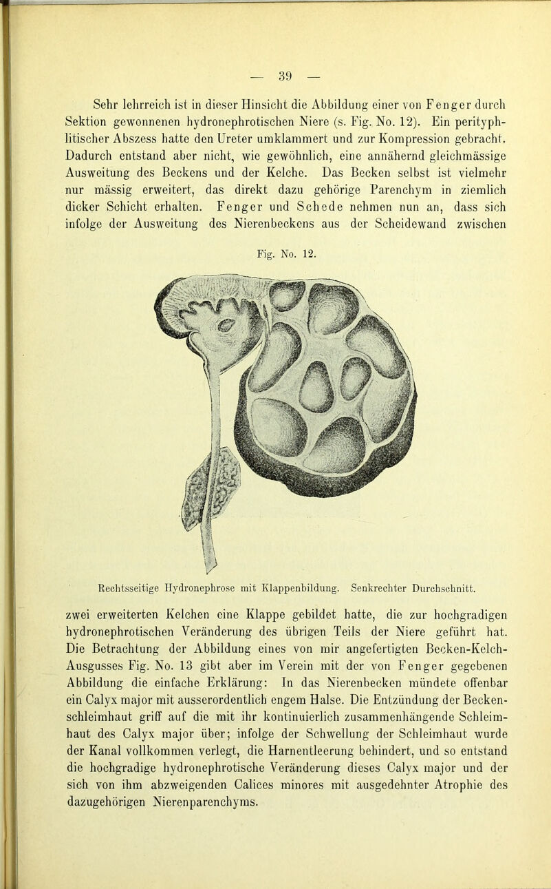Sehr lehrreich ist in dieser Hinsicht die Abbildung einer von Fenger durch Sektion gewonnenen hydronephrotischen Niere (s. Fig. No. 12). Ein perityph- litischer Abszess hatte den Ureter umklammert und zur Kompression gebracht. Dadurch entstand aber nicht, wie gewöhnlich, eine annähernd gleichmässige Ausweitung des Beckens und der Kelche. Das Becken selbst ist vielmehr nur massig erweitert, das direkt dazu gehörige Parenchym in ziemlich dicker Schicht erhalten. Fenger und Schede nehmen nun an, dass sich infolge der Ausweitung des Nierenbeckens aus der Scheidewand zwischen Fig. No. 12. Rechtsseitige Hydronephrose mit Klappenbildung. Senkrechter Durchschnitt. zwei erweiterten Kelchen eine Klappe gebildet hatte, die zur hochgradigen hydronephrotischen Veränderung des übrigen Teils der Niere geführt hat. Die Betrachtung der Abbildung eines von mir angefertigten Becken-Kelch- Ausgusses Fig. No. 13 gibt aber im Verein mit der von Fenger gegebenen Abbildung die einfache Erklärung: In das Nierenbecken mündete offenbar ein Calyx major mit ausserordentlich engem Halse. Die Entzündung der Becken- schleimhaut griff auf die mit ihr kontinuierlich zusammenhängende Schleim- haut des Calyx major über; infolge der Schwellung der Schleimhaut wurde der Kanal vollkommen verlegt, die Harnentleerung behindert, und so entstand die hochgradige hydronephrotische Veränderung dieses Calyx major und der sich von ihm abzweigenden Calices minores mit ausgedehnter Atrophie des dazugehörigen Nierenparenchyms.