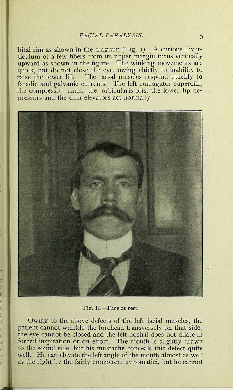 bital rim as shown in the diagram (Fig. i). A curious diver- ticulum of a few fibers from its upper margin turns vertically upward as shown in the figure. The winking movements are quick, but do not close the eye, owing chiefly to inability to raise the lower lid. The tarsal muscles respond quickly to faradic and galvanic currents. The left corrugator supercilii, the compressor naris, the orbicularis oris, the lower lip de- pressors and the chin elevators act normally. Fig. II.—Face at rest. Owing to the above defects of the left facial muscles, the patient cannot wrinkle the forehead transversely on that side; the eye cannot be closed and the left nostril does not dilate in forced inspiration or on effort. The mouth is slightly drawn to the sound side, but his mustache conceals this defect quite well. He can elevate the left angle of the mouth almost as well as the right by the fairly competent zygomatici, but he cannot