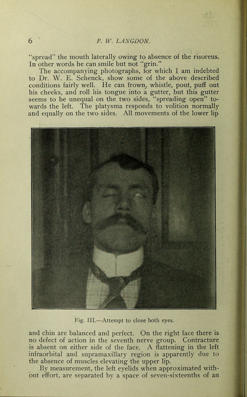 “spread the mouth laterally owing to absence of the risoreus. In other words he can smile but not “grin.” The accompanying photographs, for which I am indebted to Dr. W. E. Schenck, show some of the above described conditions fairly well. He can frown, whistle, pout, puff out his cheeks, and roll his tongue into a gutter, but this gutter seems to be unequal on the two sides, “spreading open” to- wards the left. The platysma responds to volition normally and equally on the two sides. All movements of the lower lip Fig. III.—Attempt to close both eyes. and chin are balanced and perfect. On the right face there is no defect of action in the seventh nerve group. Contracture is absent on either side of the face. A flattening in the left infraorbital and supramaxillary region is apparently due to the absence of muscles elevating the upper lip. By measurement, the left eyelids when approximated with- out effort, are separated by a space of seven-sixteenths of an