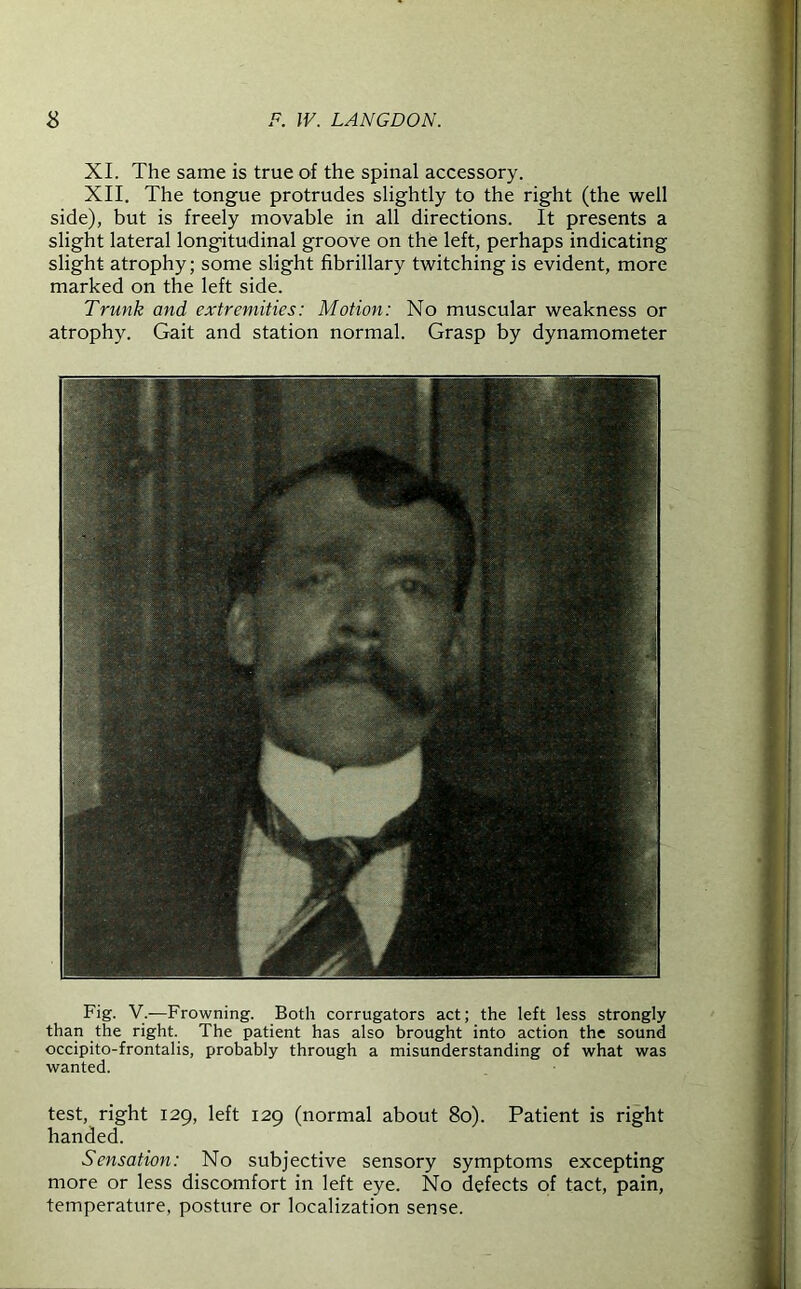 XI. The same is true of the spinal accessory. XII. The tongue protrudes slightly to the right (the well side), but is freely movable in all directions. It presents a slight lateral longitudinal groove on the left, perhaps indicating slight atrophy; some slight fibrillary twitching is evident, more marked on the left side. Trunk and extremities: Motion: No muscular weakness or atrophy. Gait and station normal. Grasp by dynamometer Fig. V.—Frowning. Both corrugators act; the left less strongly than the right. The patient has also brought into action the sound occipito-frontalis, probably through a misunderstanding of what was wanted. test, right 129, left 129 (normal about 80). Patient is right handed. Sensation: No subjective sensory symptoms excepting more or less discomfort in left eye. No defects of tact, pain, temperature, posture or localization sense.