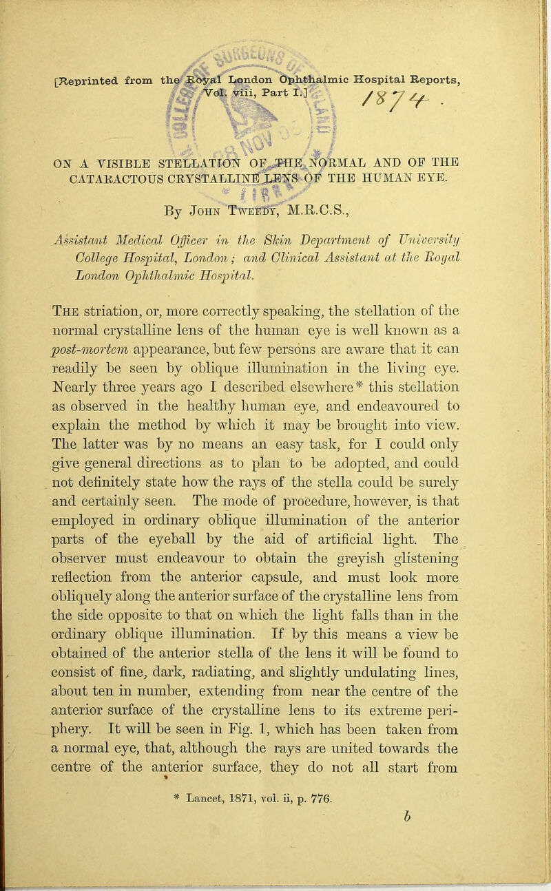 [Reprinted, from the Royal London Ophthalmic Hospital Reports, /Val. vili, Part I.] /V/^. 5 '^4 'j-' i I U' . ^ \#/ ON A VISIBLE STELLATION OF .SHE NORMAL AND OF THE CATARACTOUS CRYSTALLINE JUENS OF THE HUMAN EYE. . * fnj*Vr By John Twkedv, M.R.C.S., Assistant Medical Officer in the Skin Department of University College Hospital, London; and Clinical Assistant at the Royal London Ophthalmic Hospital. The striation, or, more correctly speaking, the stellation of the normal crystalline lens of the human eye is well known as a post-mortem appearance, hut few persons are aware that it can readily be seen by oblique illumination in the living eye. Nearly three years ago I described elsewhere* this stellation as observed in the healthy human eye, and endeavoured to explain the method by which it may be brought into view. The latter was by no means an easy task, for I could only give general directions as to plan to he adopted, and could not definitely state how the rays of the Stella could he surely and certainly seen. The mode of procedure, however, is that employed in ordinary oblique illumination of the anterior parts of the eyeball by the aid of artificial light. The observer must endeavour to obtain the greyish glistening reflection from the anterior capsule, and must look more obliquely along the anterior surface of the crystalline lens from the side opposite to that on which the light falls than in the ordinary oblique illumination. If by this means a view lie obtained of the anterior stella of the lens it will be found to consist of fine, dark, radiating, and slightly undulating lines, about ten in number, extending from near the centre of the anterior surface of the crystalline lens to its extreme peri- phery. It will be seen in Fig. 1, which has been taken from a normal eye, that, although the rays are united towards the centre of the anterior surface, they do not all start from Lancet, 1871, vol. ii, p. 776. b