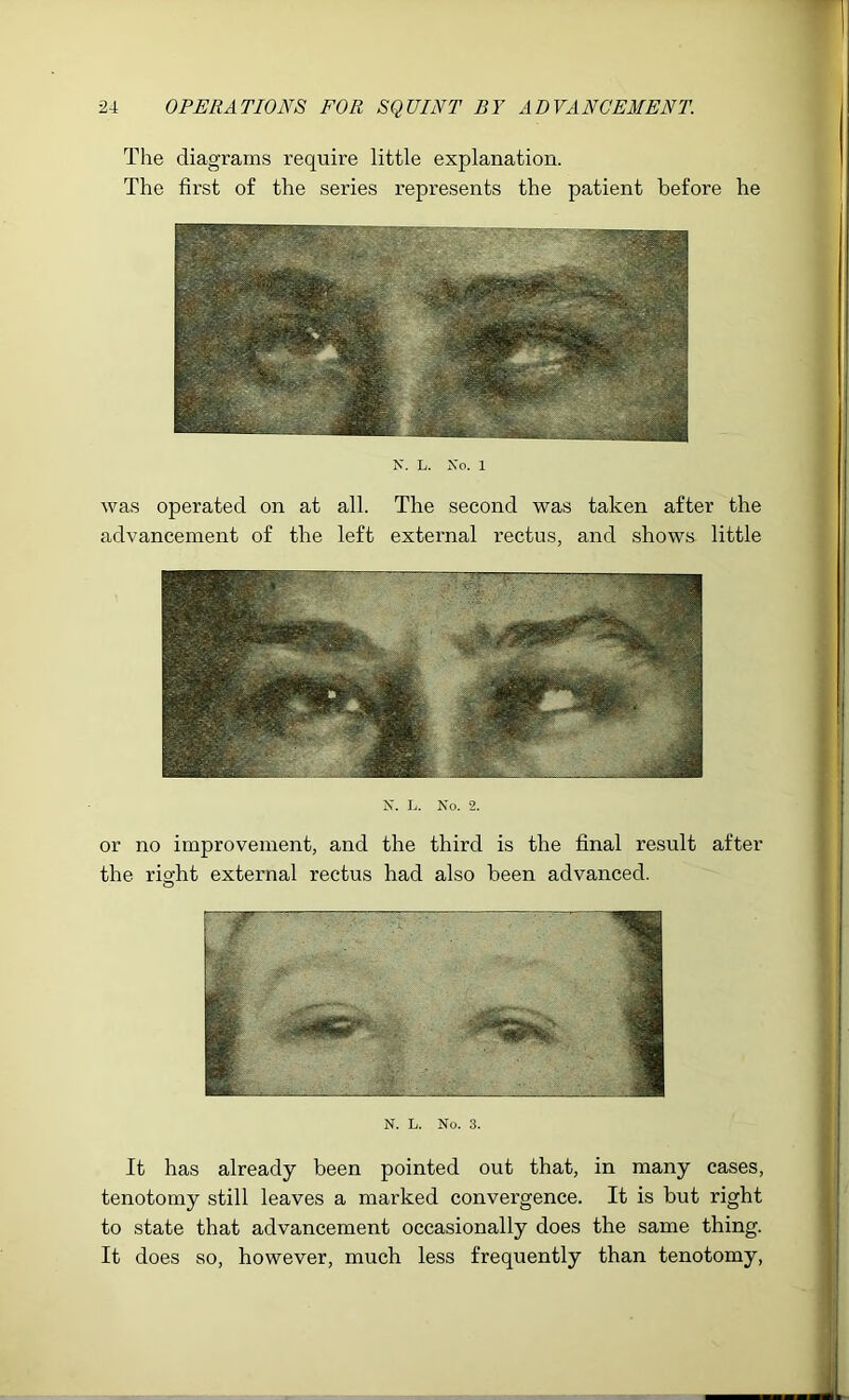 The diagrams require little explanation. The first of the series represents the patient before he N. L. Xo. 1 was operated on at all. The second was taken after the advancement of the left external rectus, and shows little X. L. Xo. 2. or no improvement, and the third is the final result after the riofht external rectus had also been advanced. o X. L. No. 3. It has already been pointed out that, in many cases, tenotomy still leaves a marked convergence. It is but right to state that advancement occasionally does the same thing. It does so, however, much less frequently than tenotomy.
