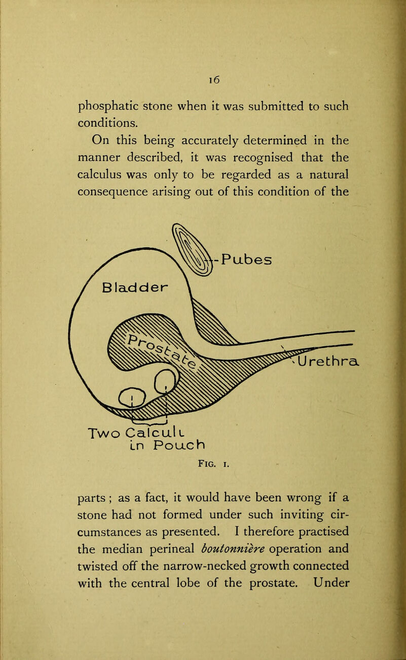 phosphatic stone when it was submitted to such conditions. On this being accurately determined in the manner described, it was recognised that the calculus was only to be regarded as a natural consequence arising out of this condition of the Fig. i. parts ; as a fact, it would have been wrong if a stone had not formed under such inviting cir- cumstances as presented. I therefore practised the median perineal boutonniere operation and twisted off the narrow-necked growth connected with the central lobe of the prostate. Under