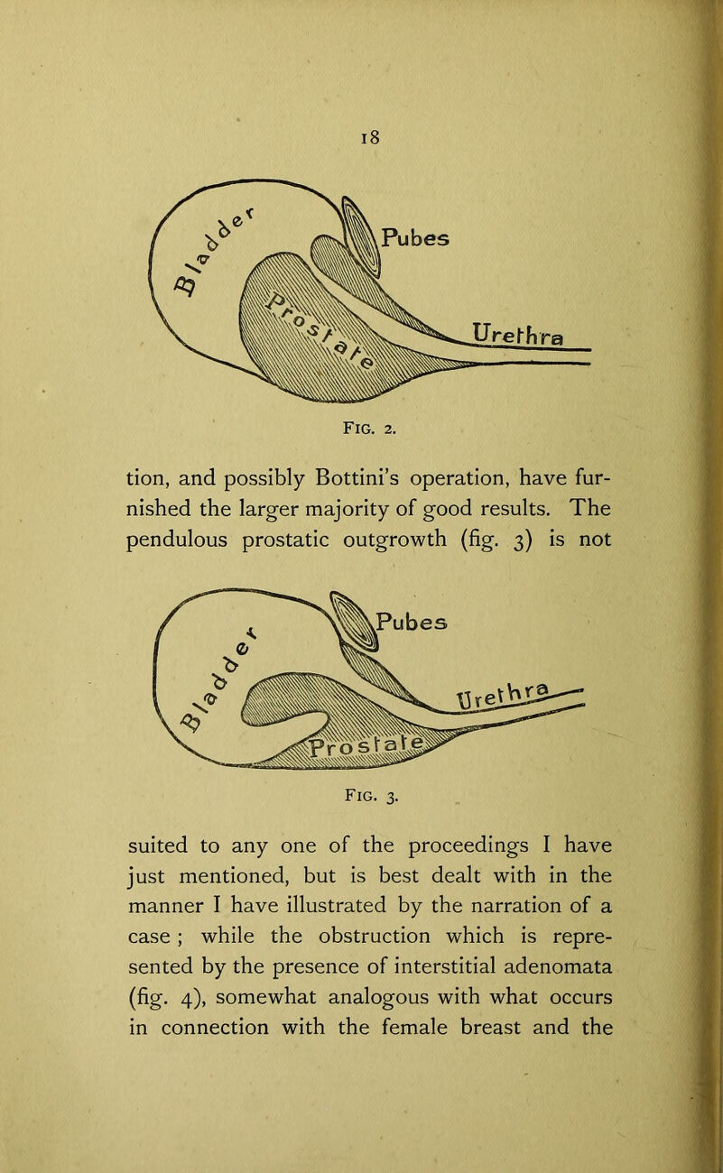 tion, and possibly Bottini’s operation, have fur- nished the larger majority of good results. The pendulous prostatic outgrowth (fig. 3) is not suited to any one of the proceedings I have just mentioned, but is best dealt with in the manner I have illustrated by the narration of a case; while the obstruction which is repre- sented by the presence of interstitial adenomata (fig. 4), somewhat analogous with what occurs in connection with the female breast and the