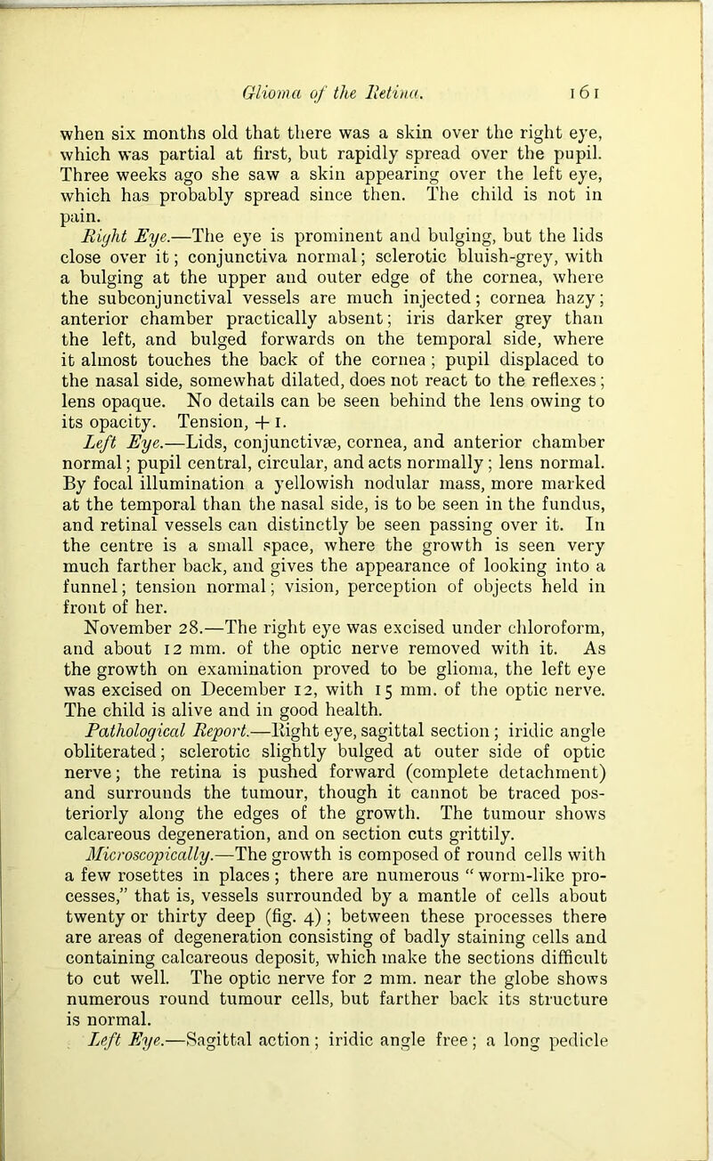 ' when six months old that there was a skin over the right eye, which was partial at first, but rapidly spread over the pupil. Three weeks ago she saw a skin appearing over the left eye, which has probably spread since then. The child is not in pain. Right Eye.—The eye is prominent and bulging, but the lids close over it; conjunctiva normal; sclerotic bluish-grey, with a bulging at the upper and outer edge of the cornea, where the subconjunctival vessels are much injected; cornea hazy; anterior chamber practically absent; iris darker grey than the left, and bulged forwards on the temporal side, where it almost touches the back of the cornea; pupil displaced to the nasal side, somewhat dilated, does not react to the reflexes; lens opaque. No details can be seen behind the lens owing to its opacity. Tension, + I. Left Eye.—Lids, conjunctive, cornea, and anterior chamber normal; pupil central, circular, and acts normally ; lens normal. By focal illumination a yellowish nodular mass, more marked at the temporal than the nasal side, is to be seen in the fundus, and retinal vessels can distinctly be seen passing over it. In the centre is a small space, where the growth is seen very much farther back, and gives the appearance of looking into a funnel; tension normal; vision, perception of objects held in front of her. November 28.—The right eye was excised under chloroform, and about 12 mm. of the optic nerve removed with it. As the growth on examination proved to be glioma, the left eye was excised on December 12, with 15 mm. of the optic nerve. The child is alive and in good health. Pathological Report.—llight eye, sagittal section ; iridic angle obliterated; sclerotic slightly bulged at outer side of optic nerve; the retina is pushed forward (complete detachment) and surrounds the tumour, though it cannot be traced pos- teriorly along the edges of the growth. The tumour shows calcareous degeneration, and on section cuts grittily. Microscopically.—The growth is composed of round cells with a few rosettes in places ; there are numerous “ worm-like pro- cesses,” that is, vessels surrounded by a mantle of cells about twenty or thirty deep (fig. 4) ; between these processes there are areas of degeneration consisting of badly staining cells and containing calcareous deposit, which make the sections difficult to cut well. The optic nerve for 2 mm. near the globe shows numerous round tumour cells, but farther back its structure is normal. Left Eye.—Sagittal action ; iridic angle free ; a long pedicle