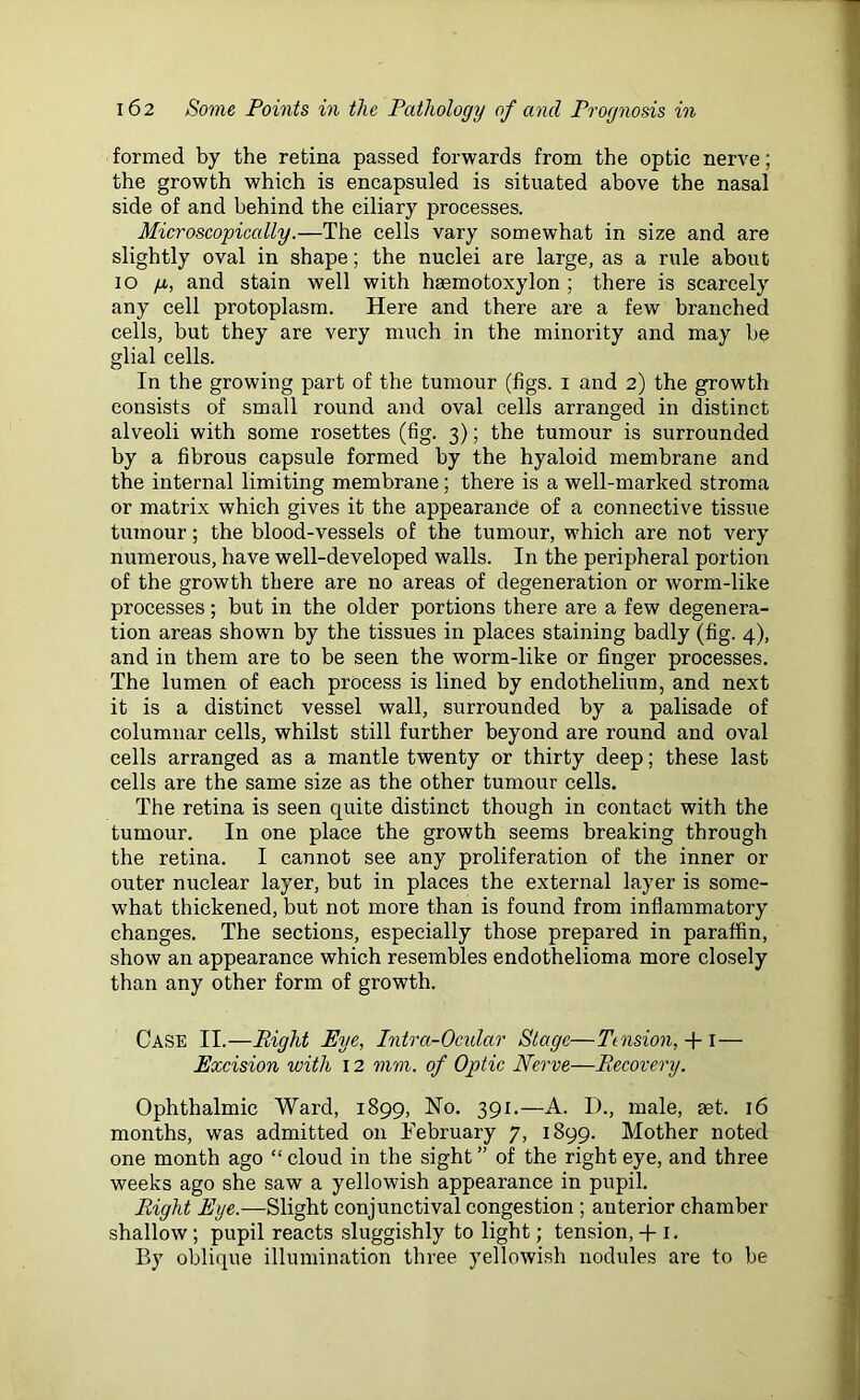formed by the retina passed forwards from the optic nerve; the growth which is encapsuled is situated above the nasal side of and behind the ciliary processes. Microscopically.—The cells vary somewhat in size and are slightly oval in shape; the nuclei are large, as a rule about io y, and stain well with haemotoxylon ; there is scarcely any cell protoplasm. Here and there are a few branched cells, but they are very much in the minority and may he glial cells. In the growing part of the tumour (figs, i and 2) the growth consists of small round and oval cells arranged in distinct alveoli with some rosettes (fig. 3); the tumour is surrounded by a fibrous capsule formed by the hyaloid membrane and the internal limiting membrane; there is a well-marked stroma or matrix which gives it the appearance of a connective tissue tumour; the blood-vessels of the tumour, which are not very numerous, have well-developed walls. In the peripheral portion of the growth there are no areas of degeneration or worm-like processes; but in the older portions there are a few degenera- tion areas shown by the tissues in places staining badly (fig. 4), and in them are to be seen the worm-like or finger processes. The lumen of each process is lined by endothelium, and next it is a distinct vessel wall, surrounded by a palisade of columnar cells, whilst still further beyond are round and oval cells arranged as a mantle twenty or thirty deep; these last cells are the same size as the other tumour cells. The retina is seen quite distinct though in contact with the tumour. In one place the growth seems breaking through the retina. I cannot see any proliferation of the inner or outer nuclear layer, but in places the external layer is some- what thickened, but not more than is found from inflammatory changes. The sections, especially those prepared in paraffin, show an appearance which resembles endothelioma more closely than any other form of growth. Case II.—Right Eye, Intra-Ocular Stage—Tension,-f 1 — Excision with 12 mm. of Optic Nerve—Recovery. Ophthalmic Ward, 1899, No. 391.—A. D., male, set. 16 months, was admitted on February 7, 1899. Mother noted one month ago “ cloud in the sight ” of the right eye, and three weeks ago she saw a yellowish appearance in pupil. Right Eye.—Slight conjunctival congestion ; anterior chamber shallow; pupil reacts sluggishly to light; tension, + 1. By oblique illumination three yellowish nodules are to be
