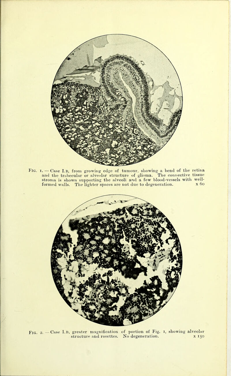 V- Fig. i. — Case I.b, from growing edge of tumour, showing a bend of the retina and the trabecular or alveolar structure of glioma. The connective tissue stroma is shown supporting the alveoli and a few blood-vessels with well- formed walls. The lighter spaces are not due to degeneration. x 60 p-IG 2. —Case I.b, greater magnification of portion of Fig. i, showing alveolar structure and rosettes. No degeneration. x 150