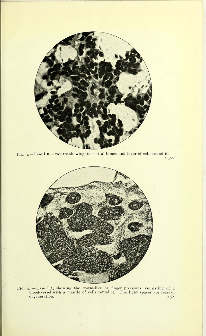 pIGi 2.—Case I.B, a rosette showing its central lumen and layer of cells round it. x 500 Fig. 4.—Case I.a, showing the worm-like or finger processes, consisting of a blood-vessel with a mantle of cells round it. The light spaces are areas of degeneration. *50