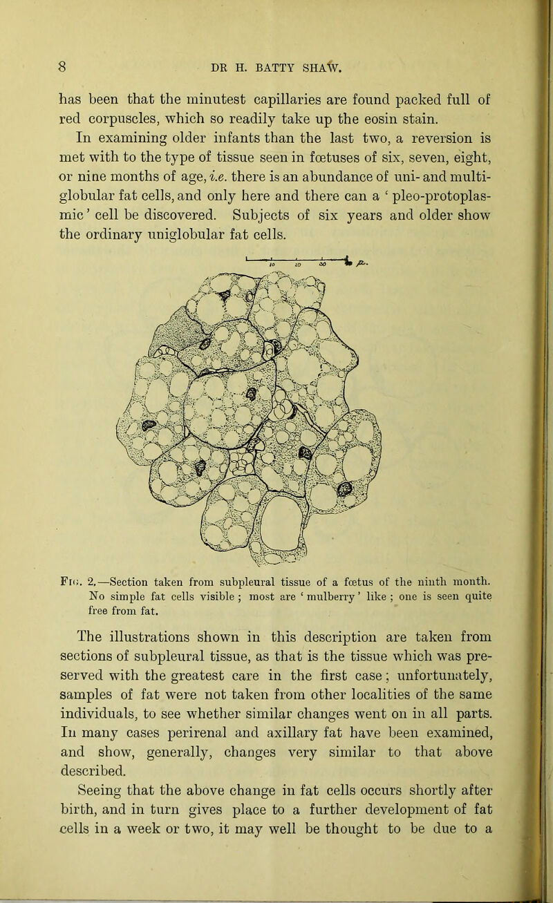 has been that the minutest capillaries are found packed full of red corpuscles, which so readily take up the eosin stain. In examining older infants than the last two, a reversion is met with to the type of tissue seen in foetuses of six, seven, eight, or nine months of age, i.e. there is an abundance of uni- and multi- globular fat cells, and only here and there can a ‘ pleo-protoplas- mic ’ cell be discovered. Subjects of six years and older show the ordinary uniglobular fat cells. lo /C-. Fi<;. 2.—Section taken from subpleural tissue of a foetus of the ninth month. No simple fat cells visible ; most are ‘ mulberry ’ like ; one is seen quite free from fat. The illustrations shown in this description are taken from sections of subpleural tissue, as that is the tissue which was pre- served with the greatest care in the first case; unfortunately, samples of fat were not taken from other localities of the same individuals, to see whether similar changes went on in all parts. In many cases perirenal and axillary fat have been examined, and show, generally, changes very similar to that above described. Seeing that the above change in fat cells occurs shortly after birth, and in turn gives place to a further development of fat cells in a week or two, it may well be thought to be due to a