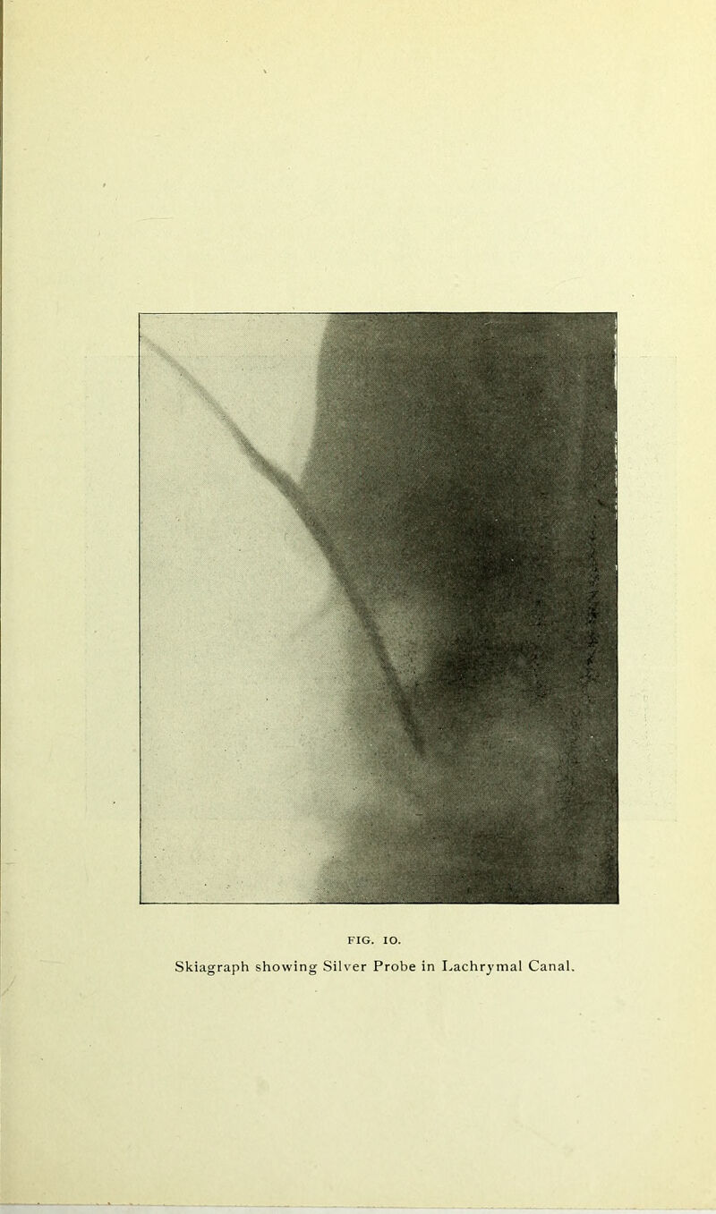 FIG. IO. Skiagraph showing Silver Probe in Lachrymal Canal.