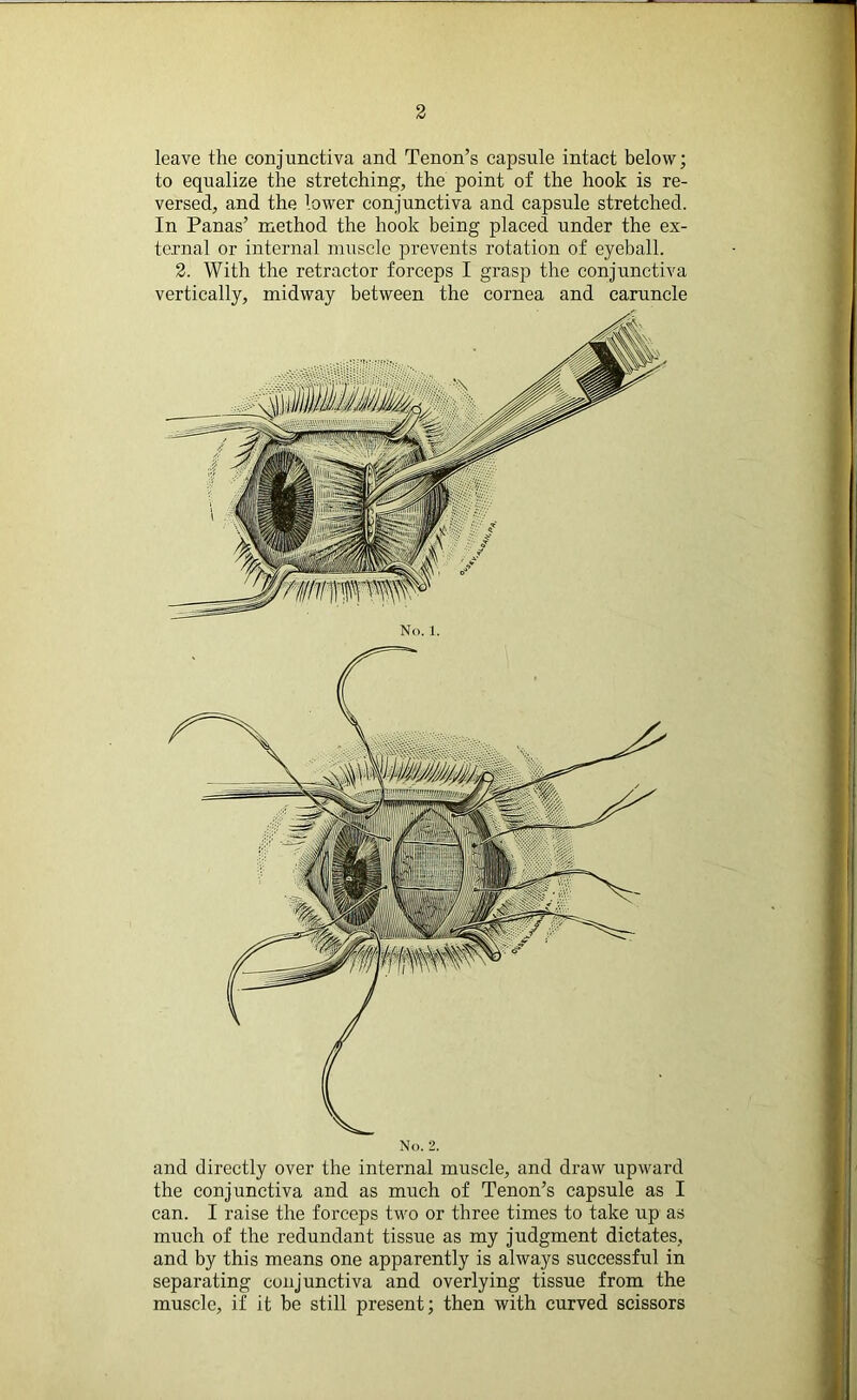 leave the conjunctiva and Tenon’s capsule intact below; to equalize the stretching, the point of the hook is re- versed, and the lower conjunctiva and capsule stretched. In Panas’ method the hook being placed under the ex- ternal or internal muscle prevents rotation of eyeball. 2. With the retractor forceps I grasp the conjunctiva vertically, midway between the cornea and caruncle and directly over the internal muscle, and draw upward the conjunctiva and as much of Tenon’s capsule as I can. I raise the forceps two or three times to take up as much of the redundant tissue as my judgment dictates, and by this means one apparently is always successful in separating conjunctiva and overlying tissue from the muscle, if it be still present; then with curved scissors