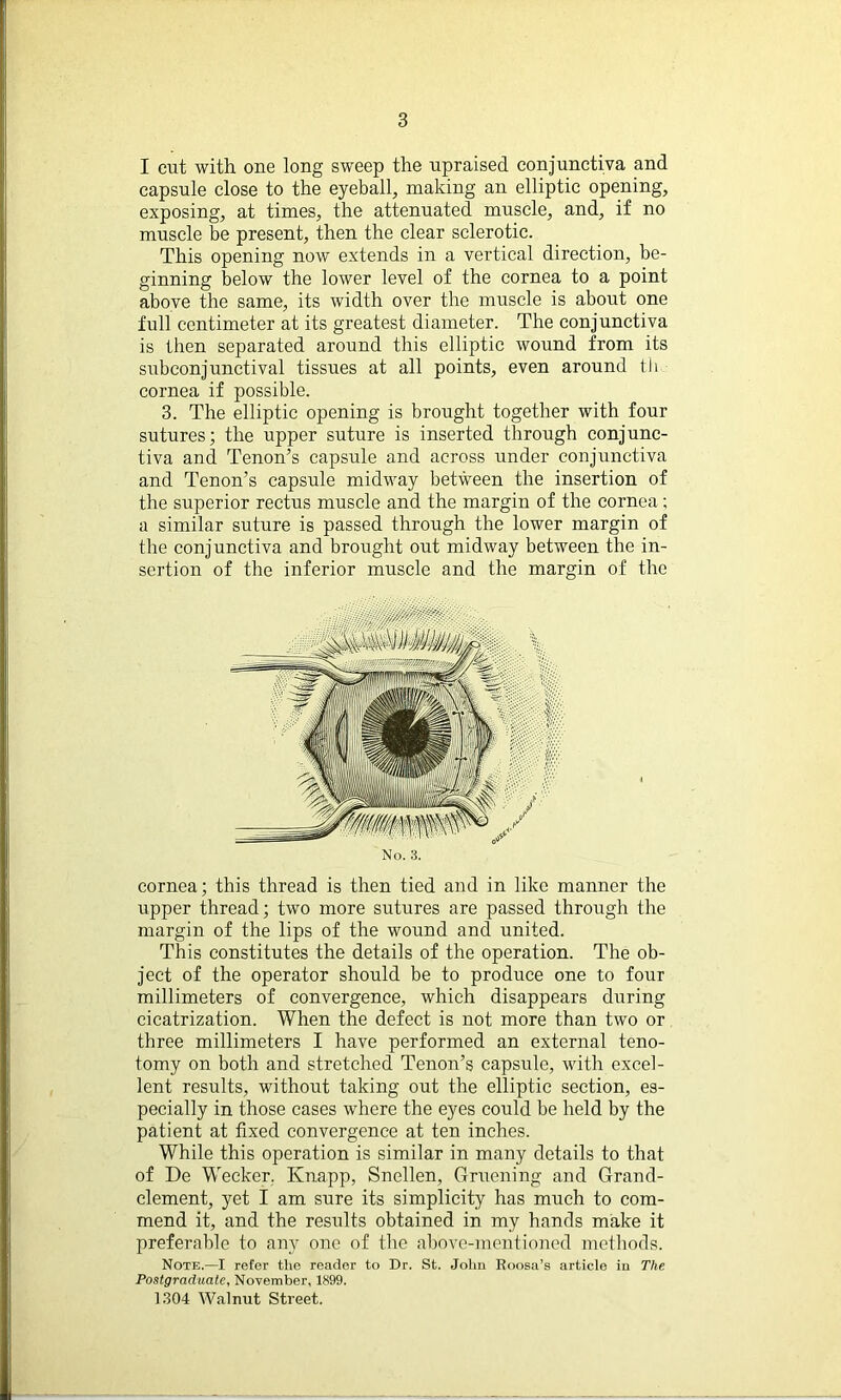 I cut with one long sweep the upraised conjunctiva and capsule close to the eyeball, making an elliptic opening, exposing, at times, the attenuated muscle, and, if no muscle be present, then the clear sclerotic. This opening now extends in a vertical direction, be- ginning below the lower level of the cornea to a point above the same, its width over the muscle is about one full centimeter at its greatest diameter. The conjunctiva is then separated around this elliptic wound from its subconjunctival tissues at all points, even around tli cornea if possible. 3. The elliptic opening is brought together with four sutures; the upper suture is inserted through conjunc- tiva and Tenon’s capsule and across under conjunctiva and Tenon’s capsule midway between the insertion of the superior rectus muscle and the margin of the cornea; a similar suture is passed through the lower margin of the conjunctiva and brought out midway between the in- sertion of the inferior muscle and the margin of the cornea; this thread is then tied and in like manner the upper thread; two more sutures are passed through the margin of the lips of the wound and united. This constitutes the details of the operation. The ob- ject of the operator should be to produce one to four millimeters of convergence, which disappears during cicatrization. When the defect is not more than two or three millimeters I have performed an external teno- tomy on both and stretched Tenon’s capsule, with excel- lent results, without taking out the elliptic section, es- pecially in those cases where the eyes could be held by the patient at fixed convergence at ten inches. While this operation is similar in many details to that of De Wecker. Knapp, Snellen, Gruening and Grand- clement, yet I am sure its simplicity has much to com- mend it, and the results obtained in my hands make it preferable to any one of the above-mentioned methods. Note.—I refer the reader to Dr. St. John Roosa’s article in The. Postgraduate, November, 1899. 1304 Walnut Street. / I No. 3.