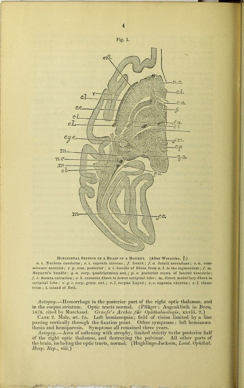 j •i Fig. 1. Horizontal Section of a Brain of a Monkey. (After Wernicke, f.) n. c. Nucleus caudatus; c.i. capsula interna; /. fornix; f.a. fornix ascendans; c. a. com- missure anterior; c.p. com. posterior ; s. i. bundle of fibres from n. 1. to the tegmentum ; /. m. Meynert’s bundle ; q. a. corp. quadrigemina ant.; p. c. posterior cornu of lateral ventricle ; /. c. fissura calcarina ; o b. crosscut fibres to lower occipital lobe ; m. direct medullary fibres to occipital lobe ; c. g. e. corp. genic, ext.; c. 1. corpus Luysii; c. e. capsula externa ; c. 1. claus- trum ; i, island of Iteil. Autopsy.—Hemorrhage in the posterior part of the right optic thalamus, and in the corpus striatum. Optic tracts normal. (Ptluger ; Augenklinik in Bern, 1878, cited by Marchand. Graefe’s Archiv fur Ophthalmologie, xxviii. 2.) Case 2. Male, aet. 75. Left hemianopsia; field of vision limited by a line passing vertically through the fixation point. Other symptoms : left hemianajs- tliesia and hemiparesis. Symptoms all remained three years. Autopsy.—Area of softening with atrophy, limited strictly to the posterior half of the right optic thalamus, and destroying the pulvinar. All other parts of the brain, includingthe optic tracts, normal. (Hughlings-Jackson, Land. Ophthal. Hasp, liep., viii.)